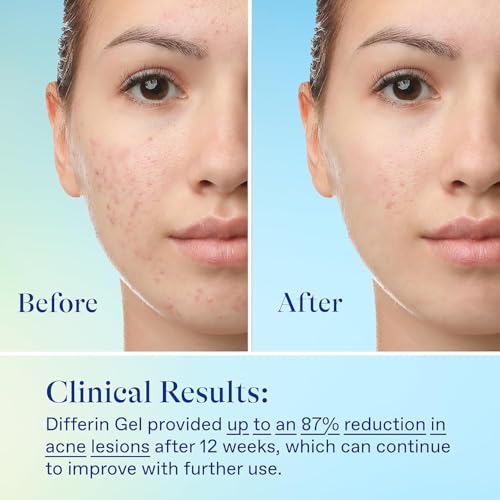 Differin Acne Skin Care Kit – 0.1% Adapalene Gel, 5% Benzoyl Peroxide Face & Body Wash for Acne & Pimple-Prone Skin