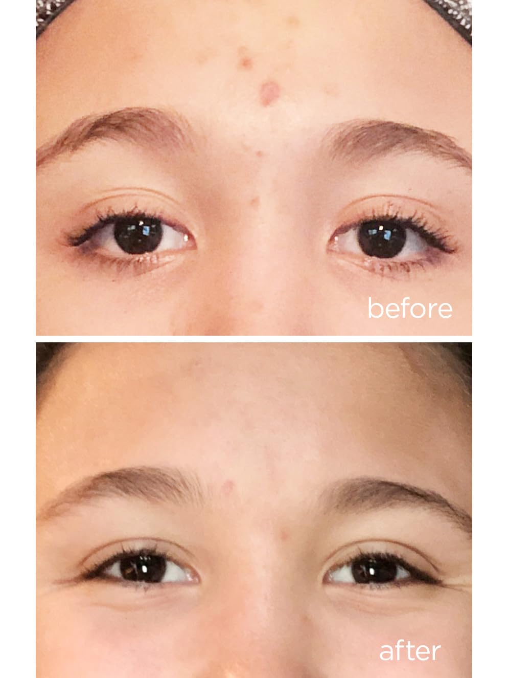 Perricone MD Acne Relief Maximum Strength Spot Gel, 0.5 fl. oz.