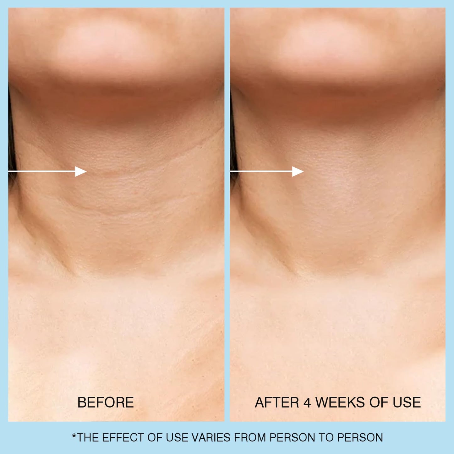 UJhay Retinol Neck Cream with Hyaluronic Acid & Caffeine – 3-in-1 Moisturizer for Neck, Chest & Face, Reduces Fine Lines & Dullness, 50ml