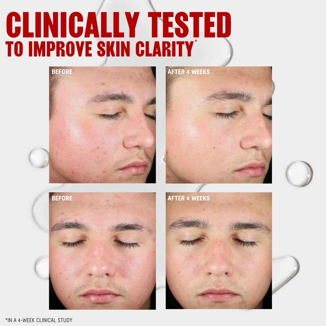 Thayers Blemish Clearing Salicylic Acid Toner, Acne Treatment Face Toner with 2% Salicylic Acid, Soothing and Non-Stripping Skin Care, 12 Fl Oz