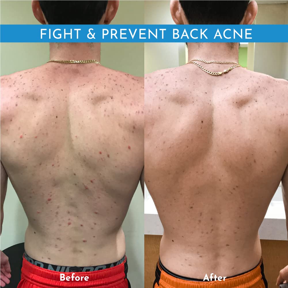 Truly Clear 1-Step Plant-Based Acne Treatment for Face, Chest & Back – Non-Drying, Salicylic + Hyaluronic Acid, Rosacea Safe