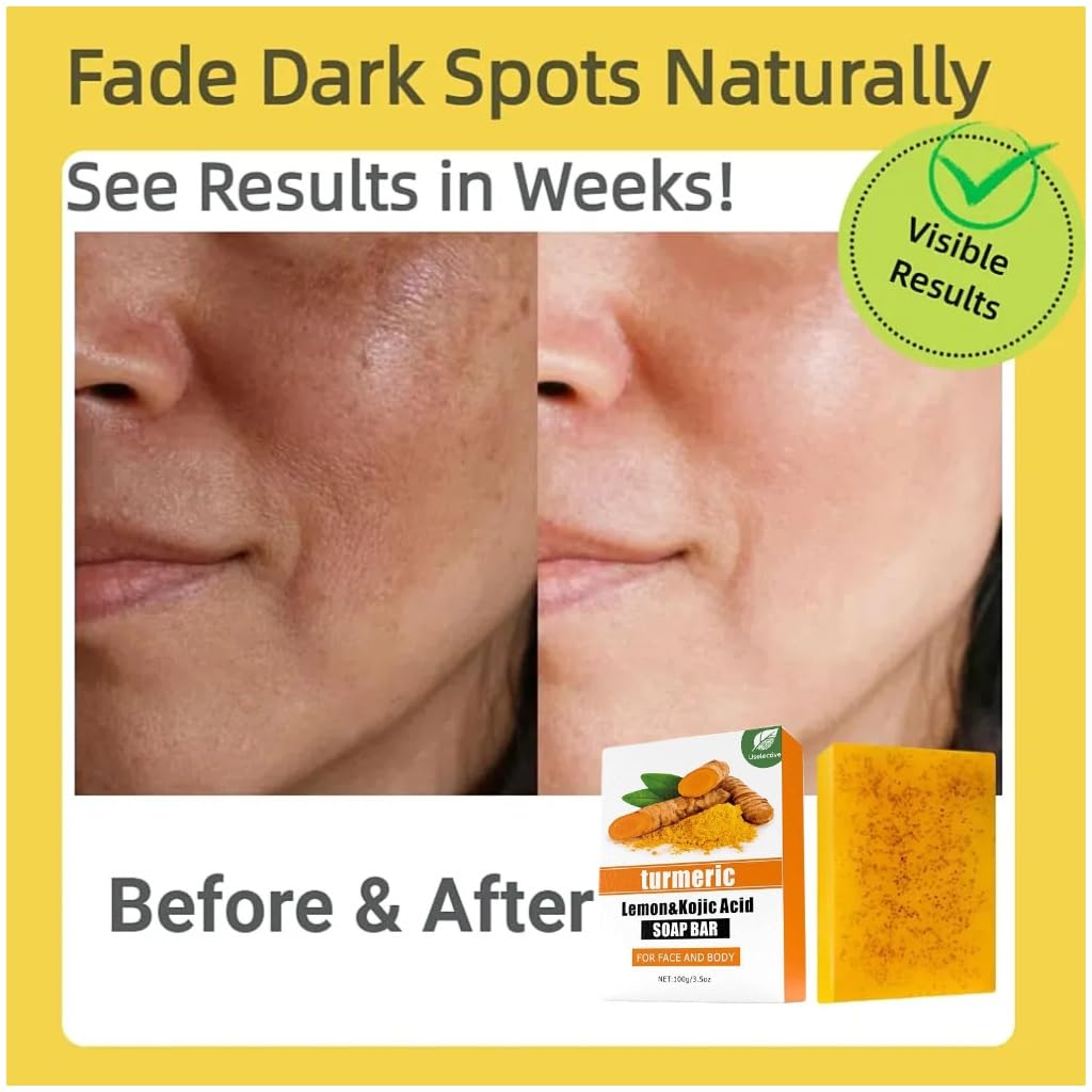 Uselective Kojic Acid & Turmeric Soap for Dark Spot Removal – Skin Lightening with Vitamin C, Retinol, Shea & Lemon Oil, SLS-Free