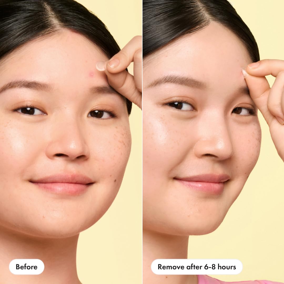 Mighty Patch Mini Invisible+ X-Small Hydrocolloid Acne Pimple Patches, Covers Zits & Blemishes, Blends Into Skin, 30 Count (10mm)