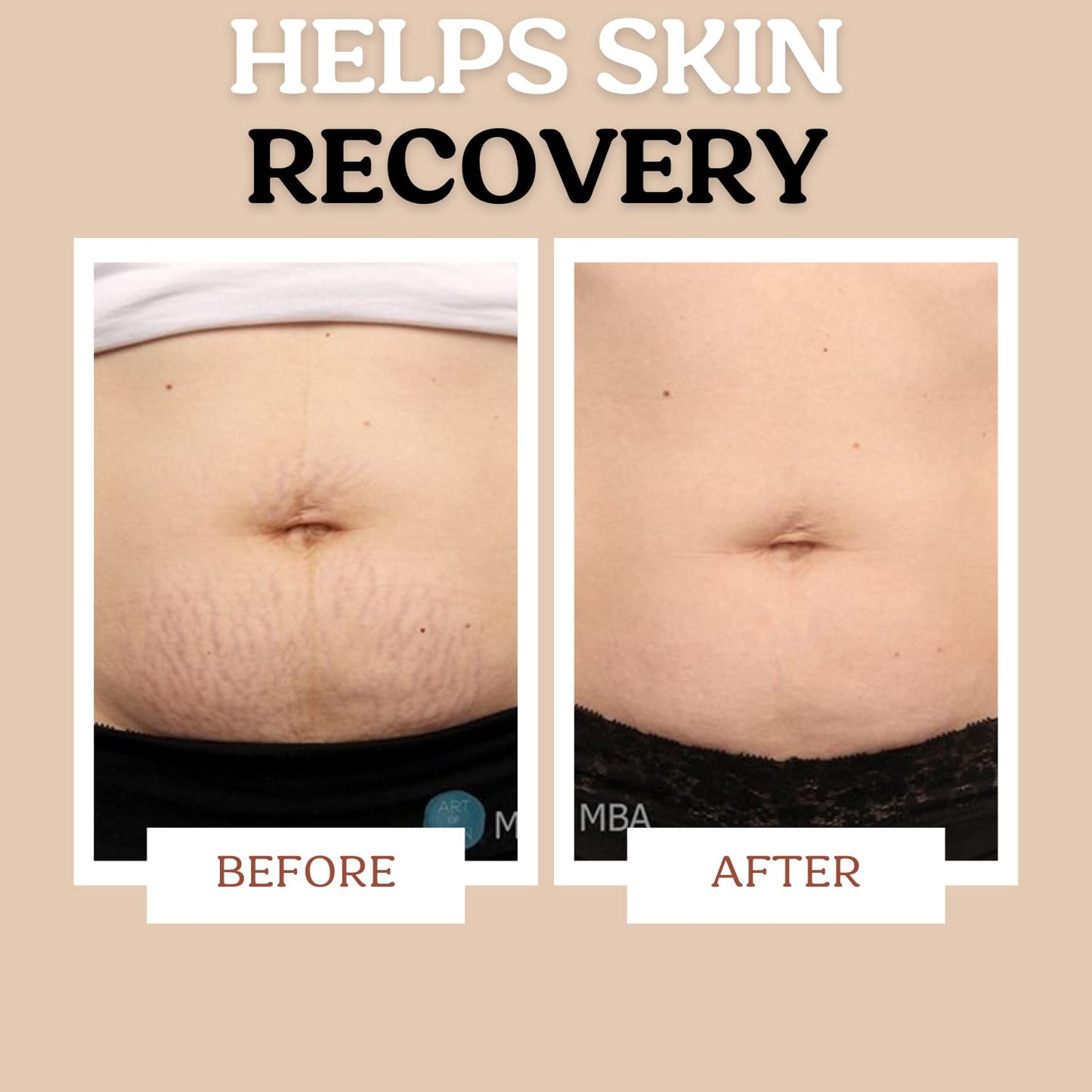 Roe Wellness Stretch Mark Cream for Sensitive Skin – Plant-Based, Hydrating, Firms & Improves Elasticity, Long & Short-Term Care