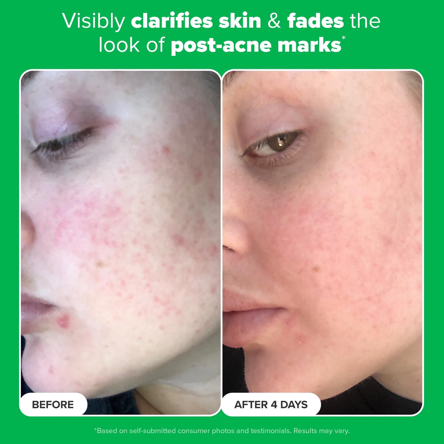 Paula's Choice BOOST 10% Azelaic Acid Booster Cream Gel Face Serum with Salicylic Acid, Oil-Free Skin Brightening Serum for Face, Fragrance-Free, 1oz