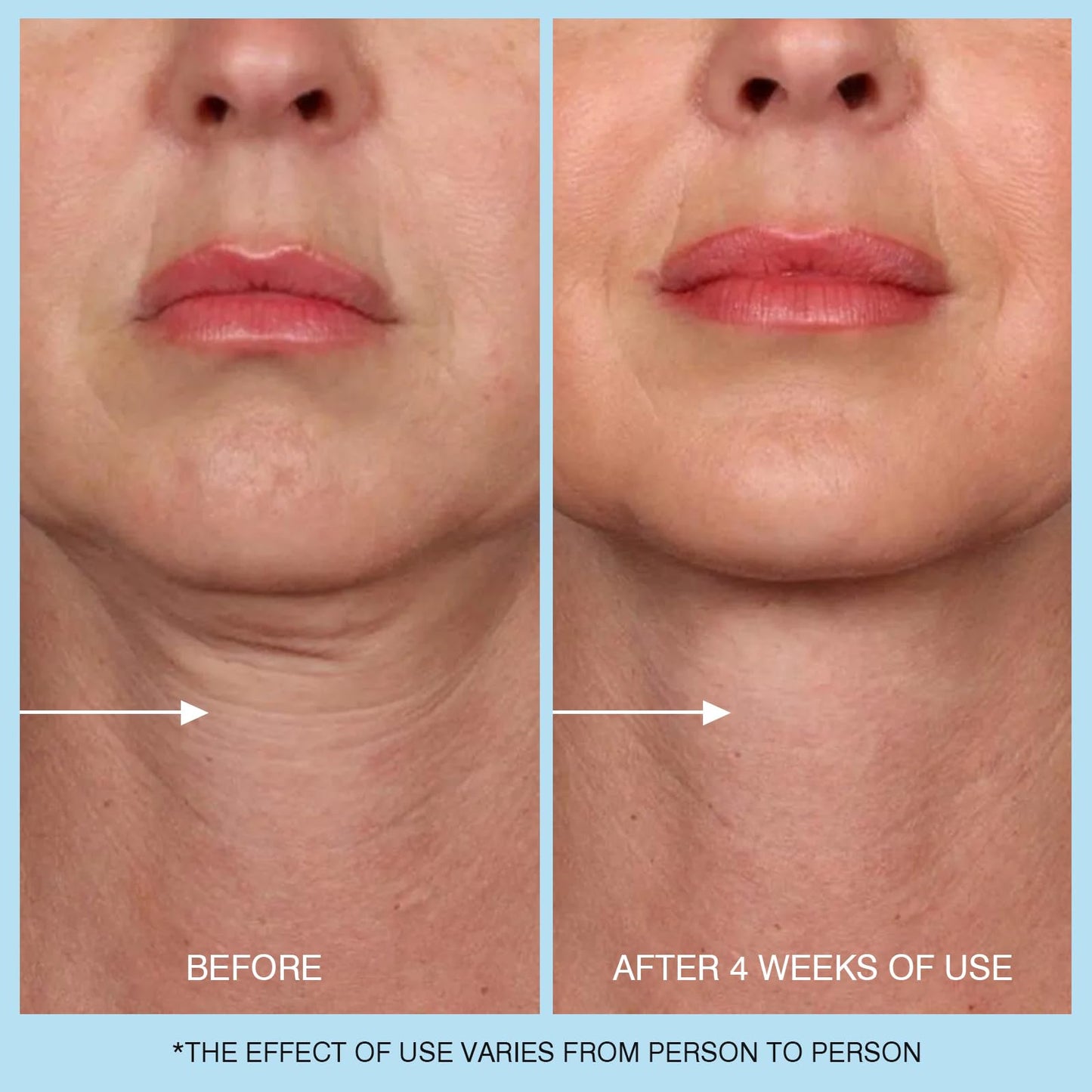 UJhay Retinol Neck Cream with Hyaluronic Acid & Caffeine – 3-in-1 Moisturizer for Neck, Chest & Face, Reduces Fine Lines & Dullness, 50ml