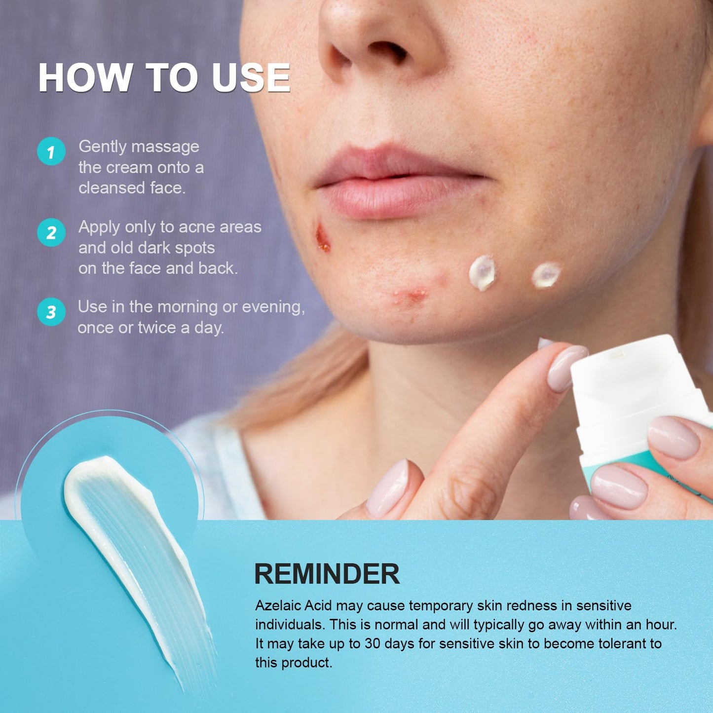 Acne & Pimple Spot Treatment Cream with 10% Azelaic Acid – Blemish, Blackhead & Cystic Acne Remover for Face, Back & Body, 1.8 oz