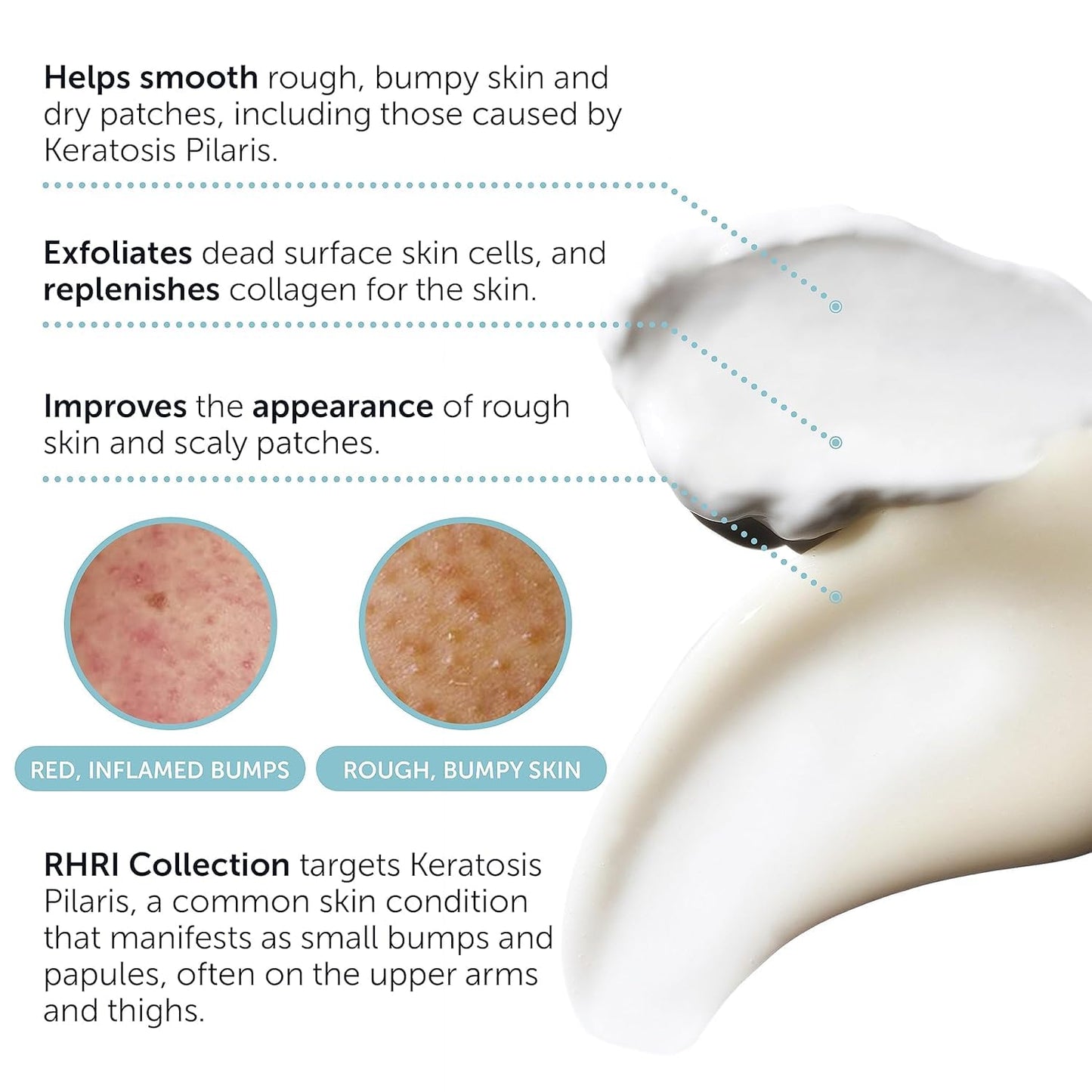 KP Bump Eraser Body Set β Keratosis Pilaris Lotion & Exfoliating Scrub for Strawberry Legs, Bumps, Redness & Dry Flaky Skin