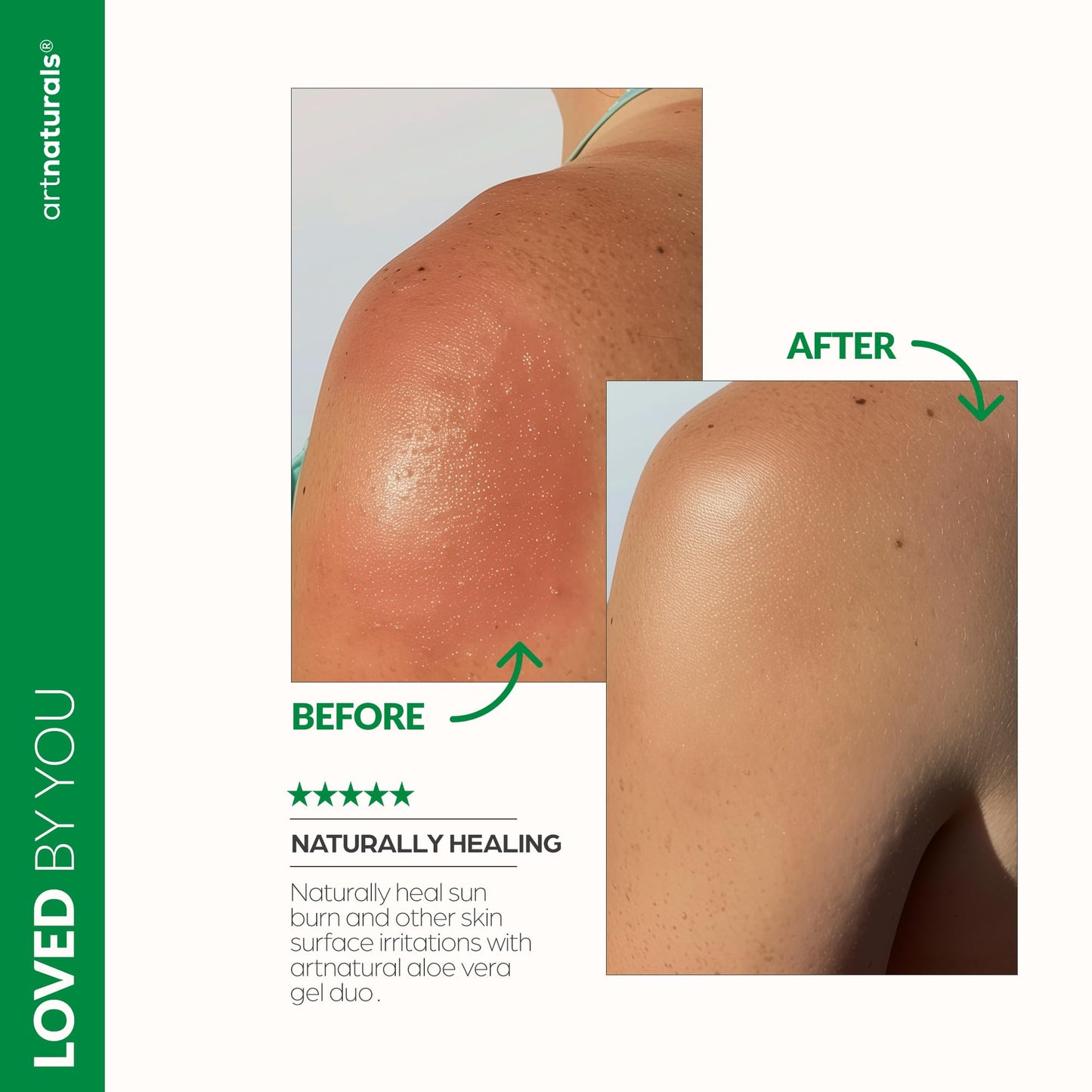 ArtNaturals Aloe Vera Gel Set, 20oz Jumbo – Soothes Sunburn, Hydrates Face, Body & Hair – Calming After-Sun Moisturizer, Freshly Harvested