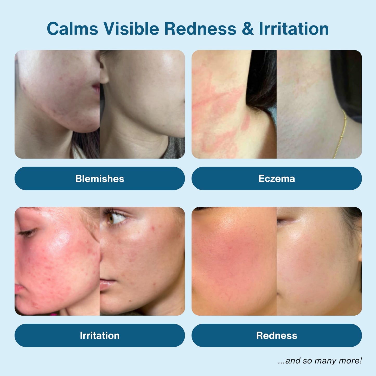 Honeydew Labs Hypochlorous Acid Spray – HOCl Mist for Acne, Eczema, Sensitive Skin, Scalp & Eyelid Care, Post-Workout & Post-Procedure, 6.8oz