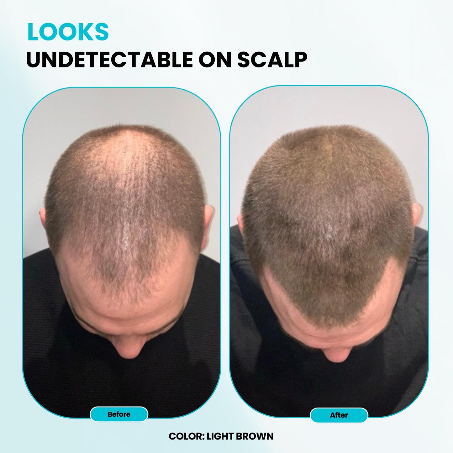 SURETHIK Hair Fibers, 15g (Dark Brown), Fills Thinning Hair for Visibly Fuller Look, Conceals Bald Spots, Natural Look, For Men & Women