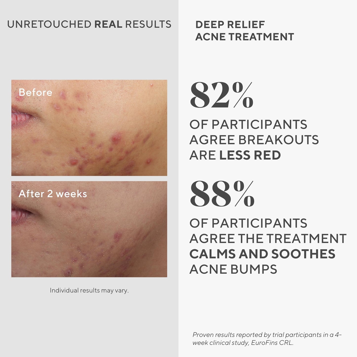 Murad Deep Relief Acne Treatment – 2% Salicylic Acid Spot Treatment for Redness, Painful Blemishes & Fast-Acting Breakout Relief, 1 fl oz