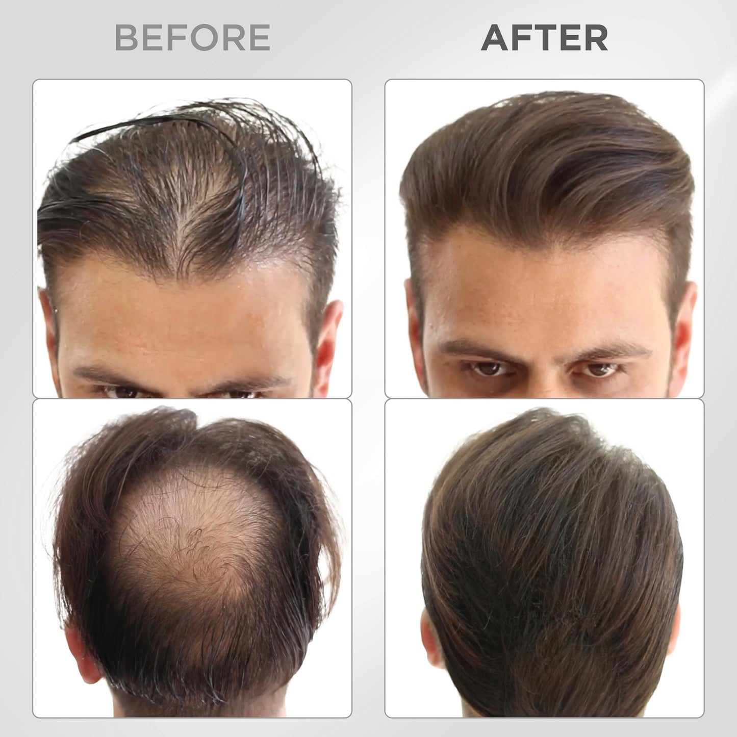 THICK FIBER Hair Fibers for Thinning Hair & Bald spots (DARK BROWN) - 25g Bottle - Conceals Hair Loss in Seconds - Hair Powder for Women & Men