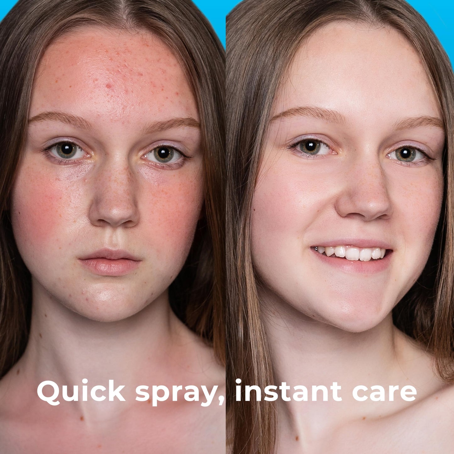 PatchRx Hypochlorous Acid Spray 8oz - HOCL Facial Cleanser for Acne, Pimples, Eczema & Redness - Kills Bacteria, Soothes Skin & Aids Recovery