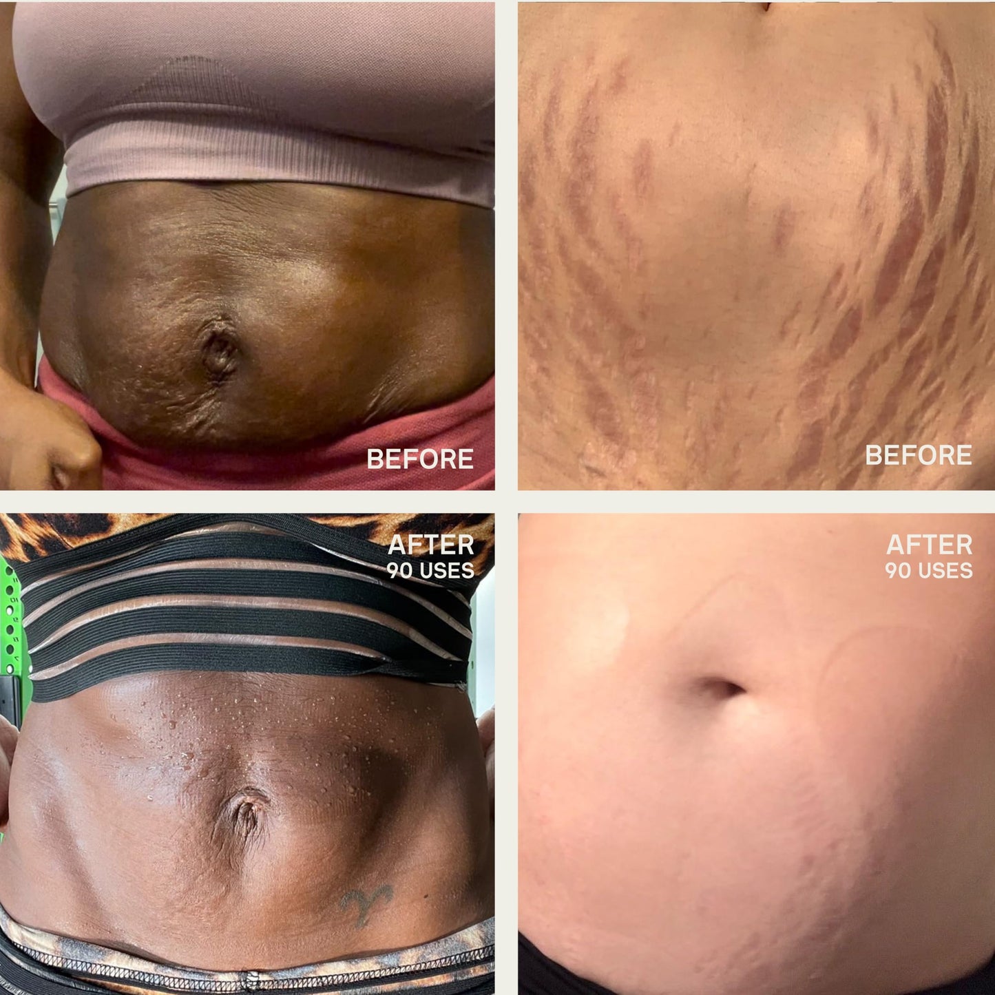 Dermaclara Large Body Patch – Silicone Stretch Mark & Scar Sheet for Pregnancy, C-Section, Belly & Body – Reusable Up to 30 Uses, 1 Patch