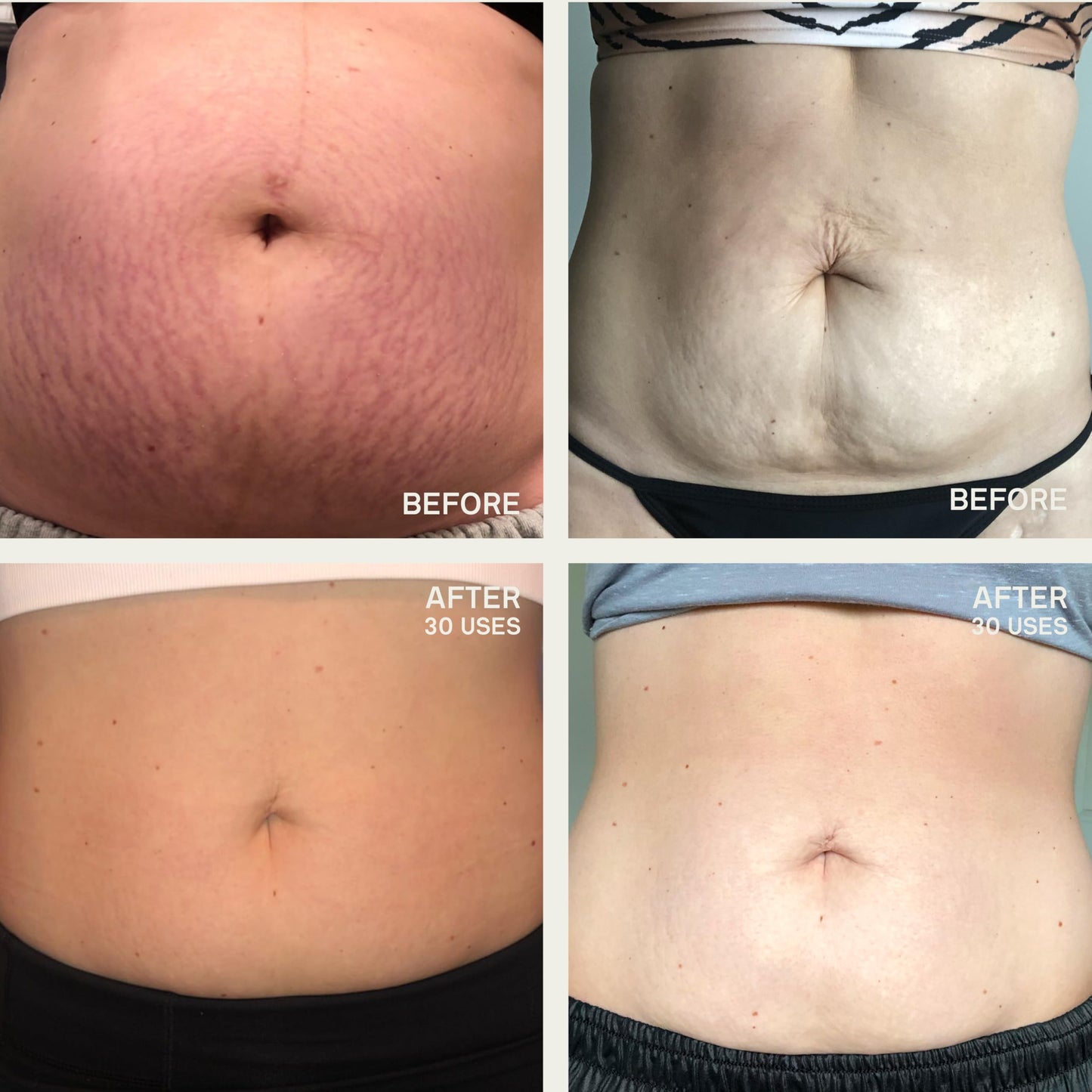 Dermaclara Large Body Patch – Silicone Stretch Mark & Scar Sheet for Pregnancy, C-Section, Belly & Body – Reusable Up to 30 Uses, 1 Patch