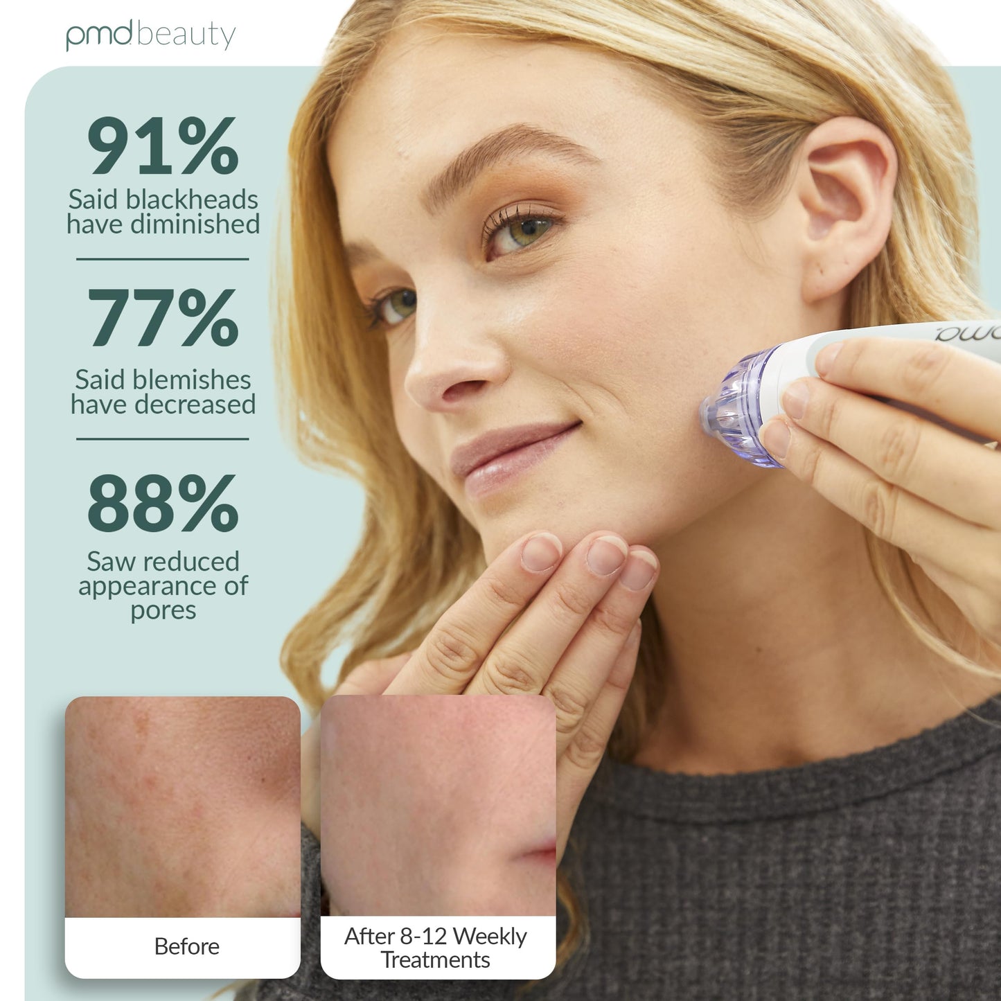 PMD Personal Microderm Classic for At-Home Use, Facial Exfoliator Tool, Microdermabrasion Machine Kit for Face and Body Skincare, Grey