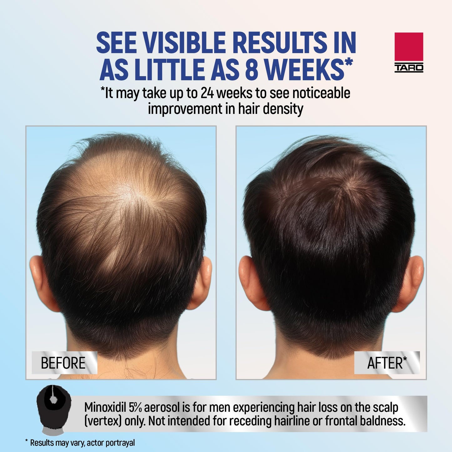 Taro Minoxidil for Men, 2.11 Oz (1 Month Supply) Clinically Proven to Regrow Hair, Topical Aerosol Foam 5%, Hair Thinning Treatment