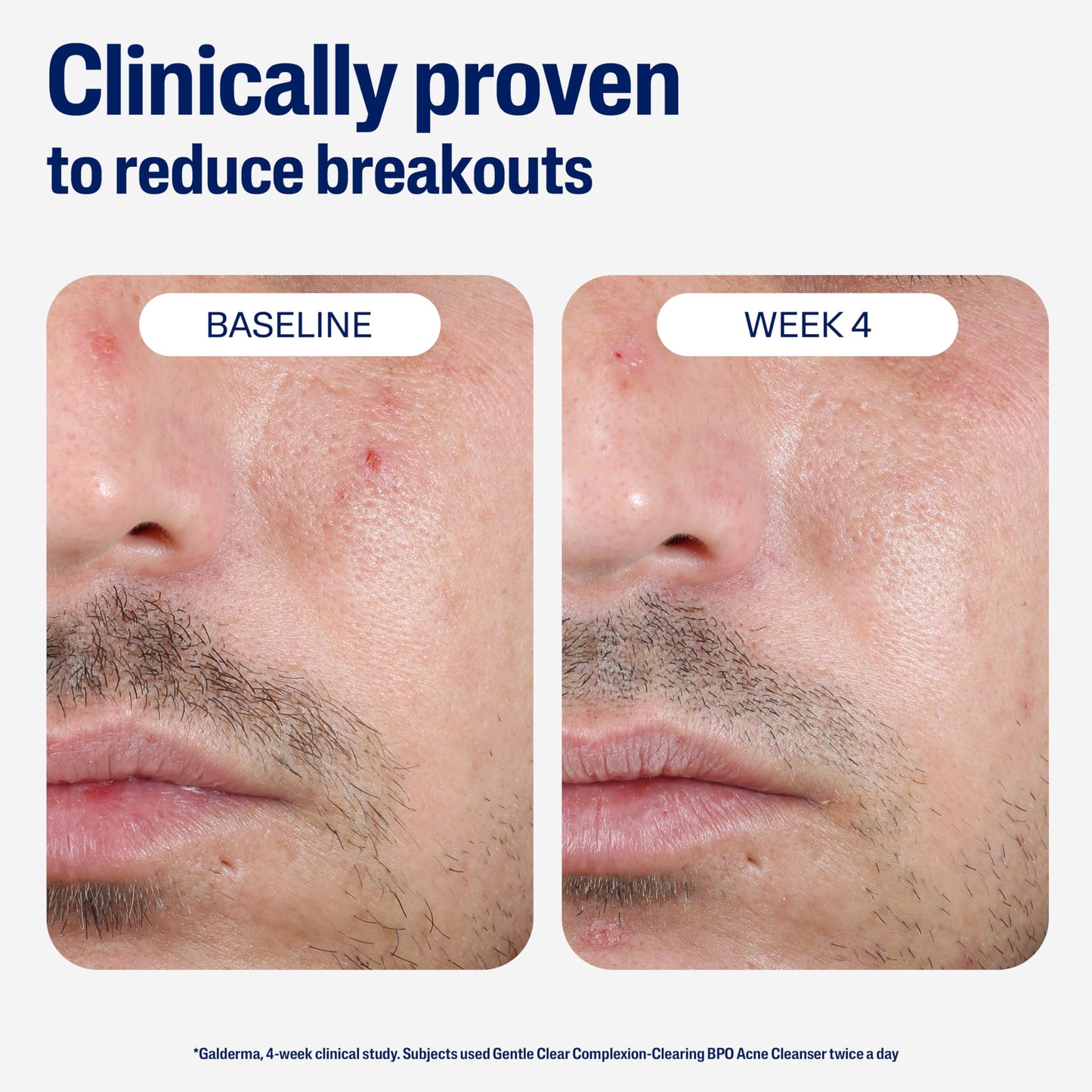 Cetaphil Gentle Clear Acne Cleanser with 2.6% Benzoyl Peroxide – Creamy, Soothing Face Wash for Sensitive & All Skin Types, 4.2 oz