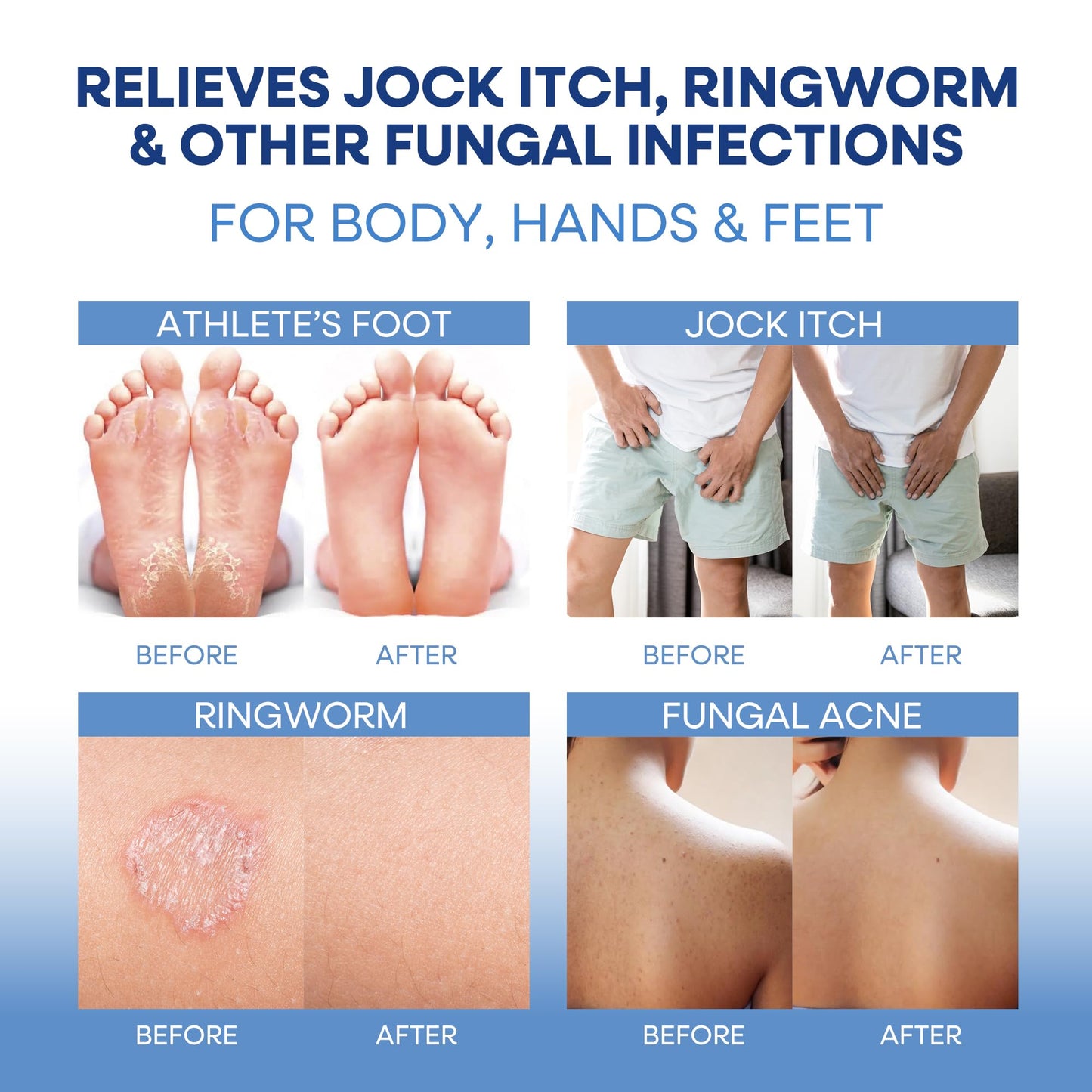 Hermon Antifungal Soap with Tea Tree Oil: Antifungal Bar Soothing Care & Relief of Itchy for Ringworm Jock Itch Tinea Versicolor Athletes Foot - Body & Face Wash