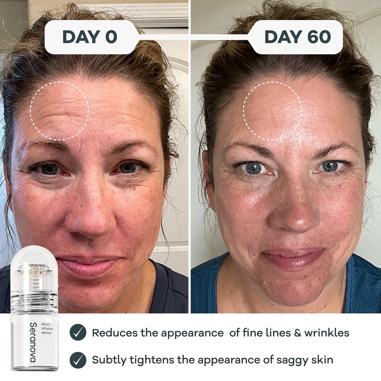 Seranova Micro Infusion Stamp 0.05mm for Face & Neck with Hyaluronic Acid & Collagen Peptide Serum – 3-Month At-Home Skin Care