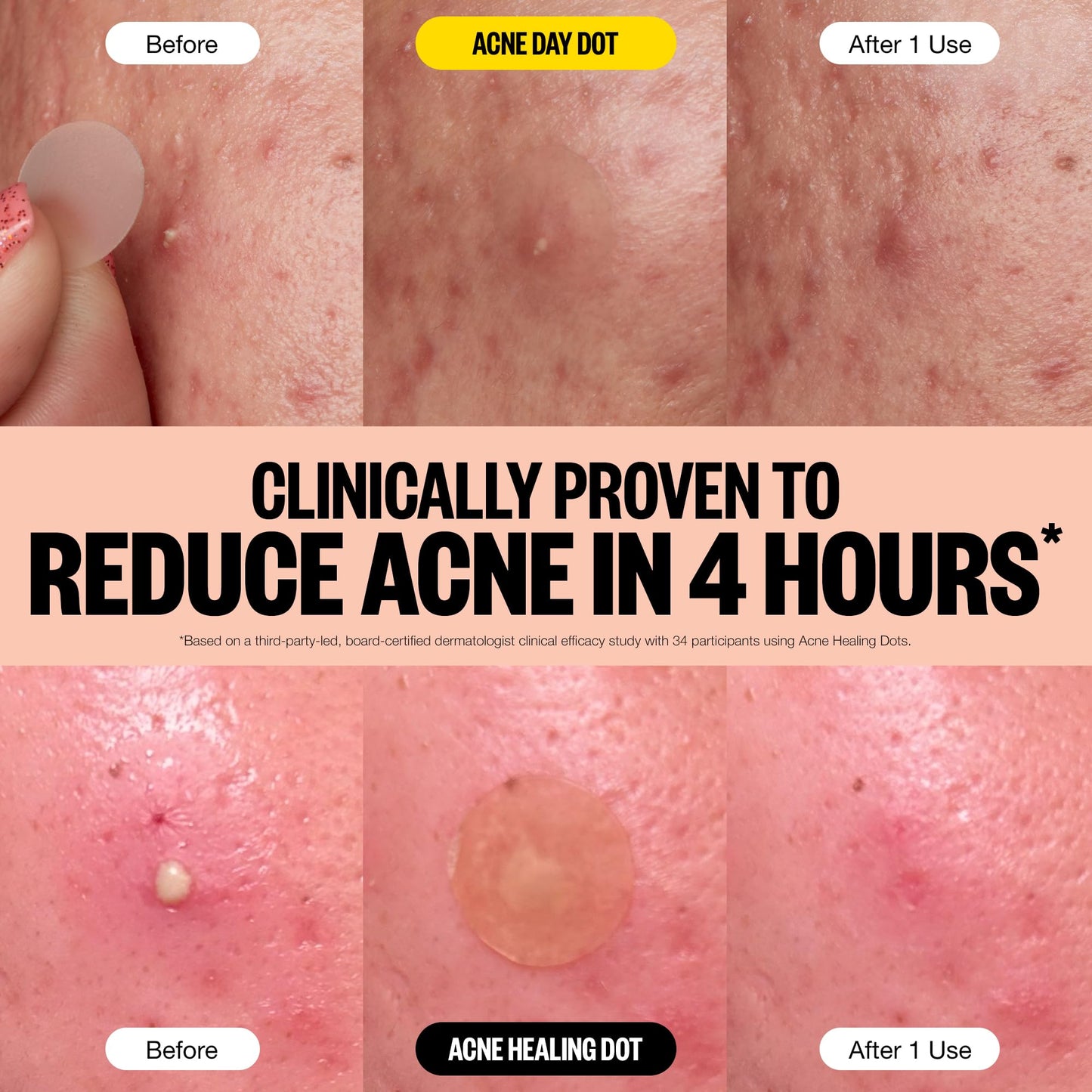 PEACE OUT Acne Day & Night Duo – Sheer Hydrocolloid Pimple Patches with Salicylic Acid, Retinol & Aloe Vera, 20 Dots for Fast Blemish Relief