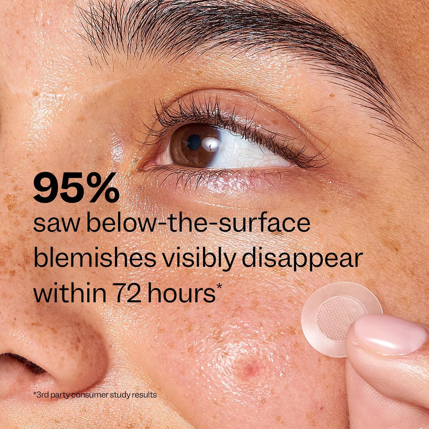 Peach Slices Deep Blemish Acne Patches – Salicylic Acid, Tea Tree, Niacinamide, Cica & Hyaluronic Acid for Early & Deep Pimples, 9ct