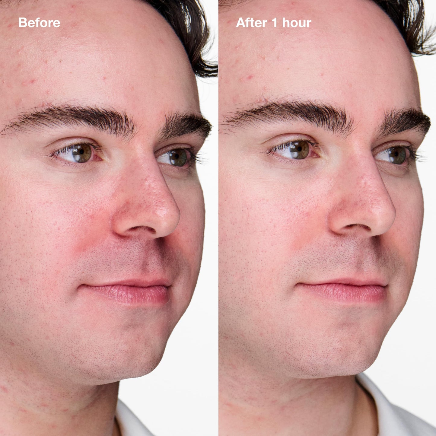 Clinique Acne Solutions Clinical Clearing Gel – Oil-Free Acne Treatment with Salicylic Acid & Witch Hazel, Soothes Skin, 0.68 fl oz