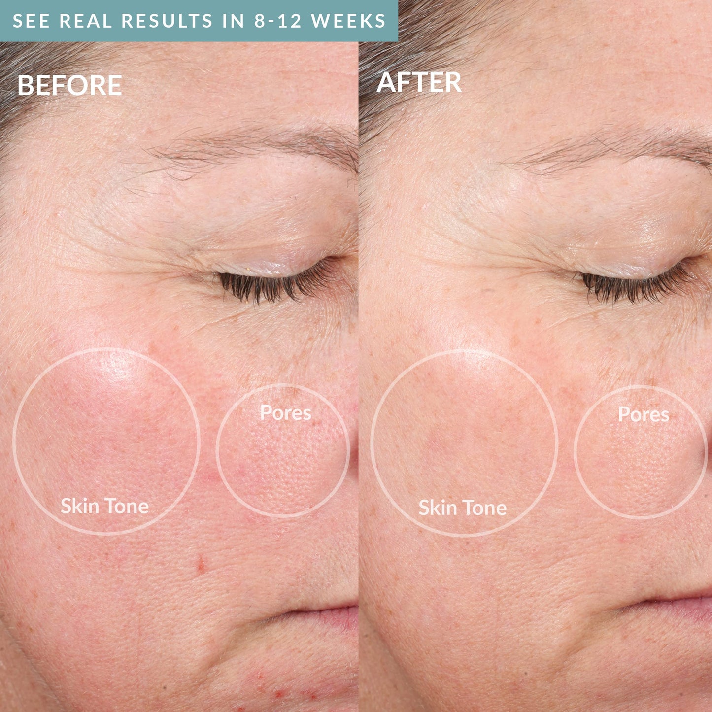 PMD Beauty Personal Microderm Elite Pro - At-Home Microdermabrasion Kit for Face & Body with Exfoliating Crystals & Adjustable Suction