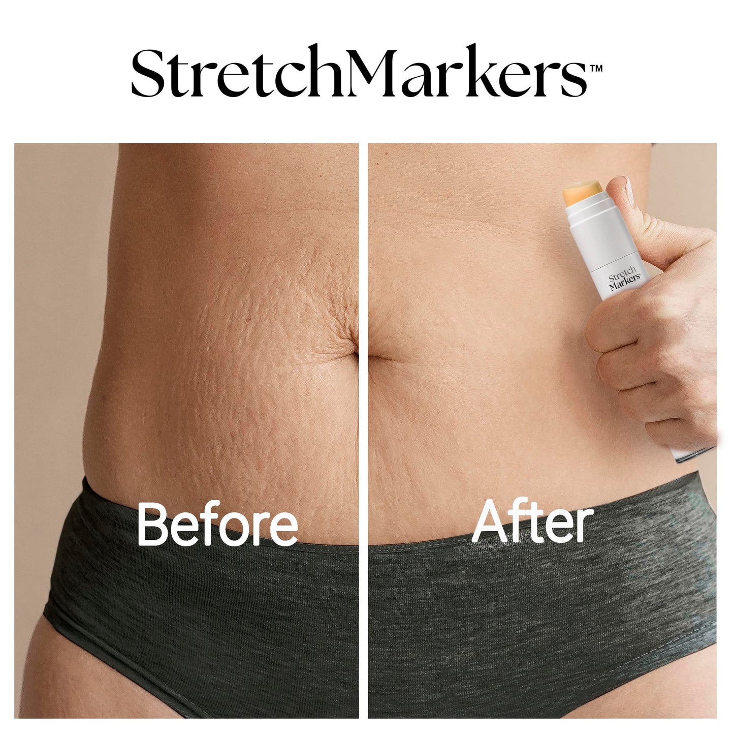 StretchMarkers Therapy Stretch Mark Cream – Reduces & Treats Marks with Retinol, Hyaluronic Acid, Peptides & 3D Stem Cells, 1 fl oz
