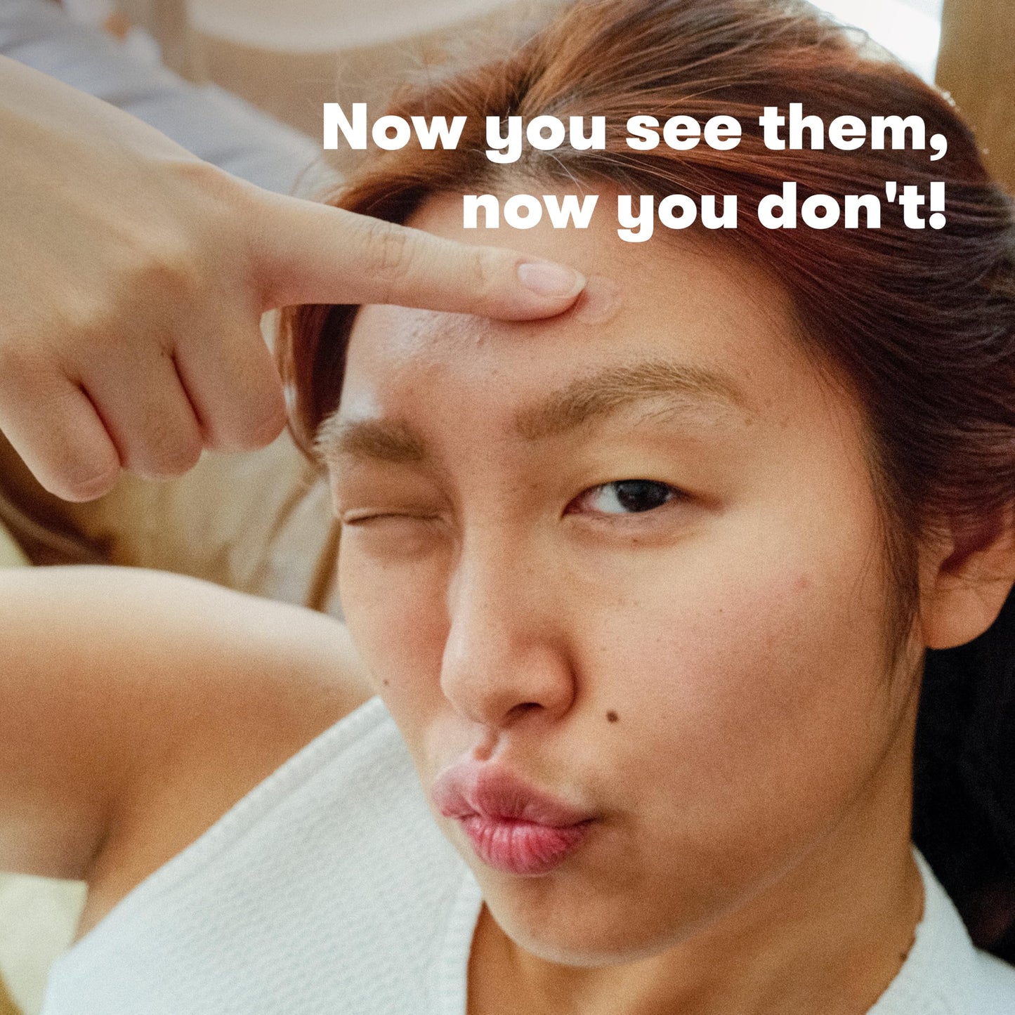 Proactiv Zits Happen® Hydrocolloid Acne Patches- Pimple Patches for Face and Back Acne with Pore Cleansing Salicylic Acid- 30 Count