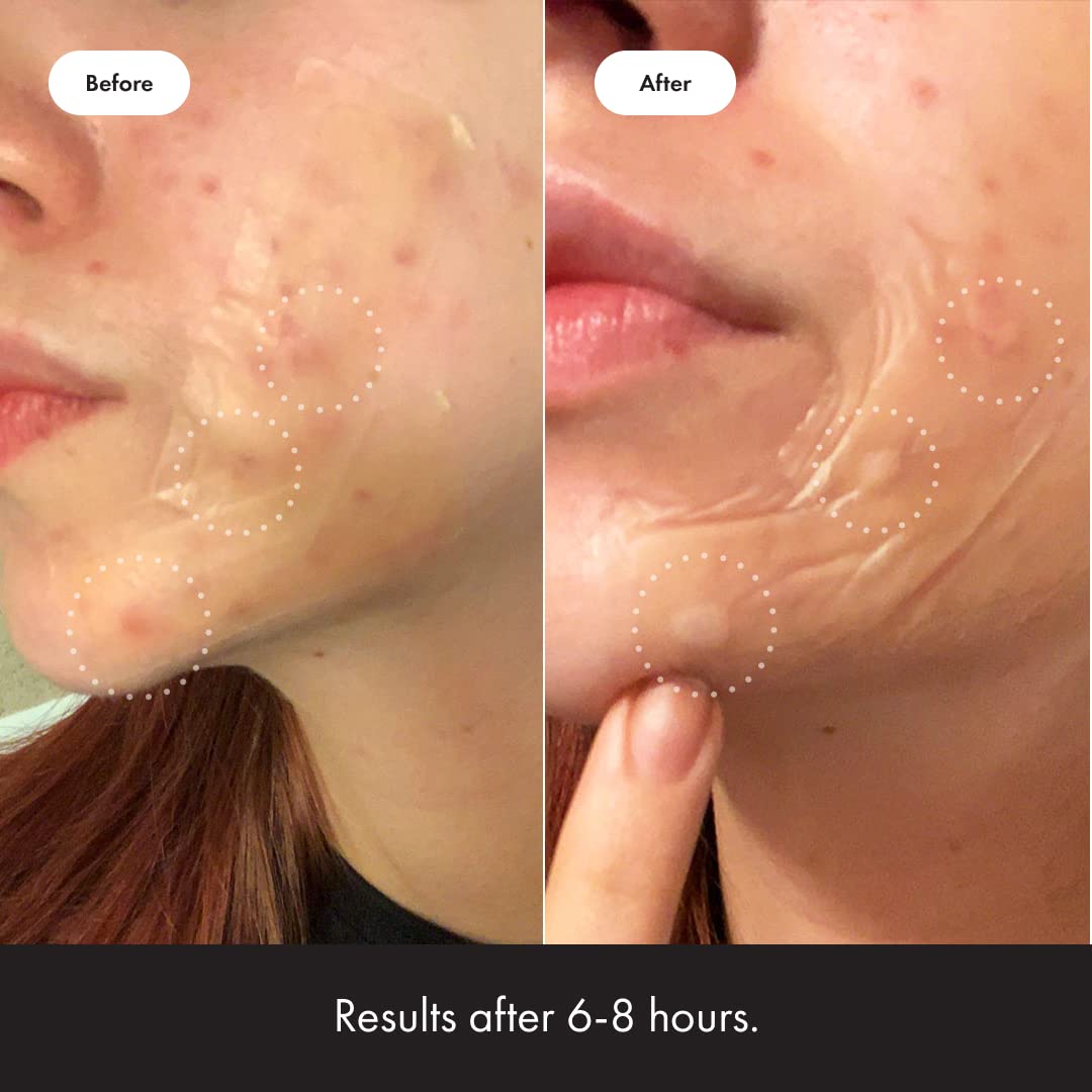 Hero Cosmetics Mighty Patch Surface Large Pimple Patches – Acne Spot Stickers for Face & Body, Hydrocolloid, Vegan, 10 Count