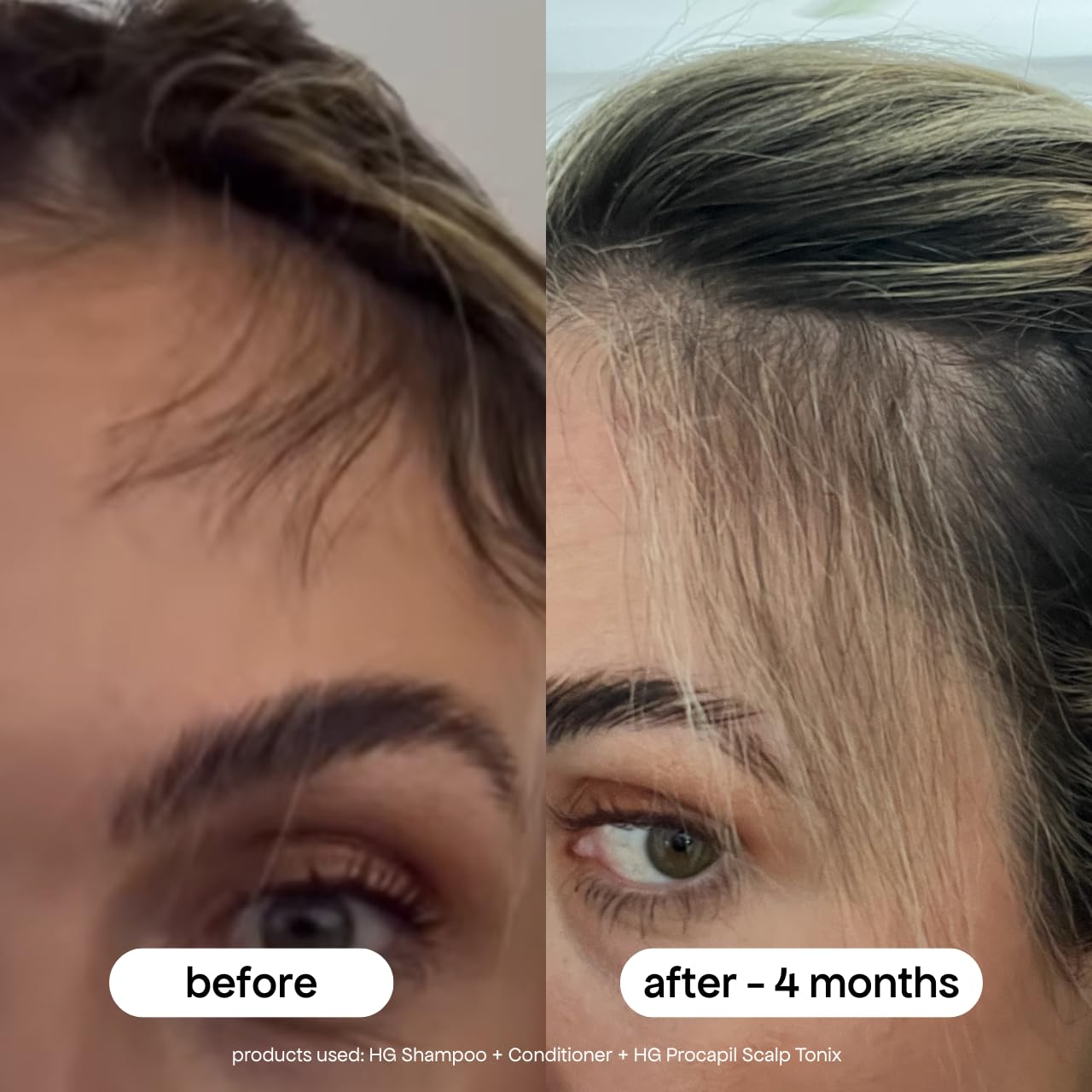 BONDIBOOST Procapil Scalp Treatment 4.23 fl oz – Daily Leave-In Serum for Thinning Hair, Thicker Hair with Procapil, Biotin & Rosemary, Sulfate-Free