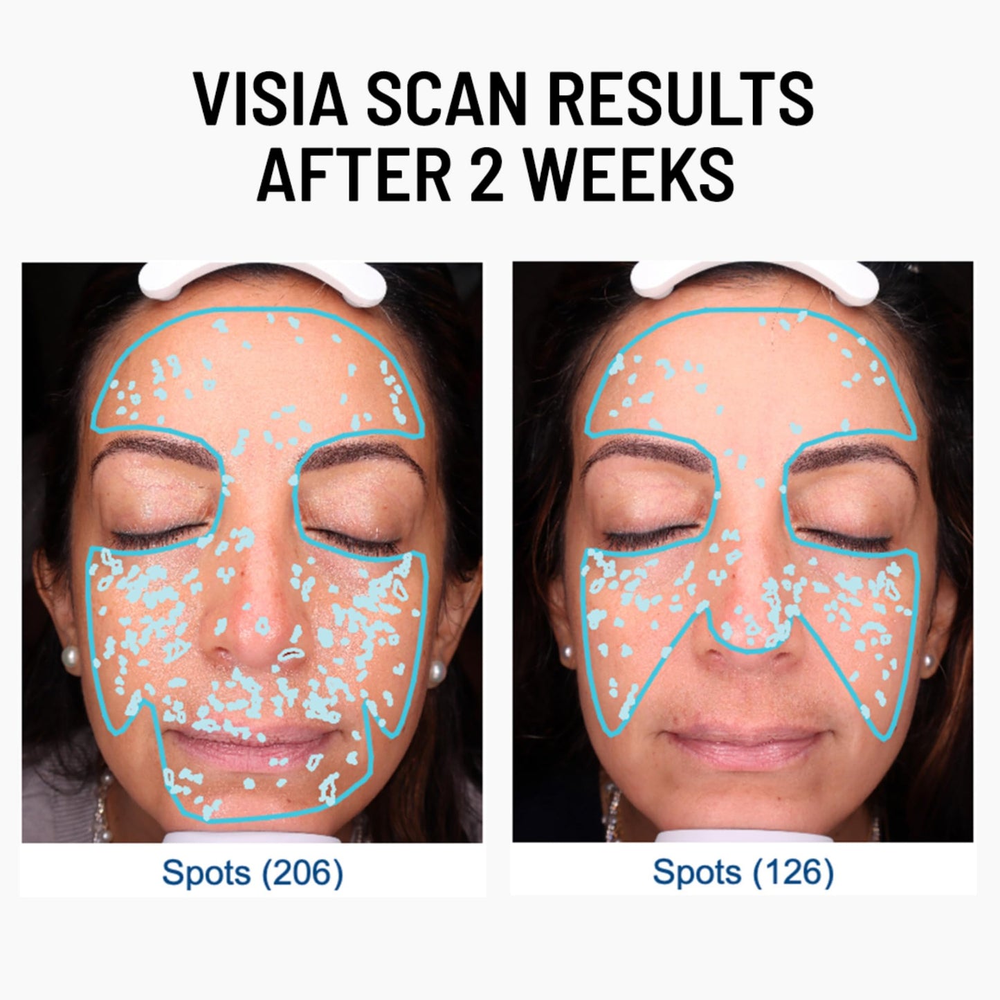 Dr. Brandt Advanced Microdermabrasion Face Exfoliator - Refines Texture, Minimizes the Look of Fine Lines & Enhances Overall Skin Tone - 2 oz