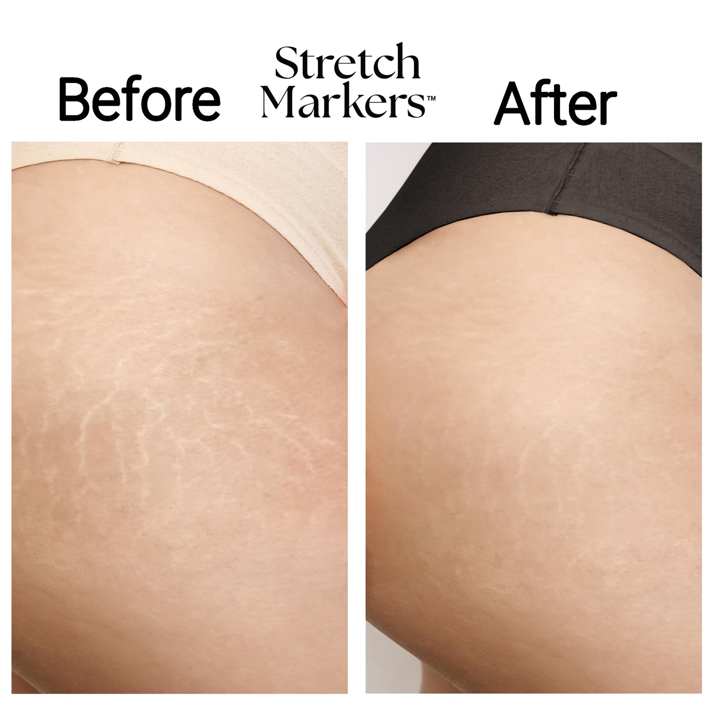 StretchMarkers Therapy Stretch Mark Cream – Reduces & Treats Marks with Retinol, Hyaluronic Acid, Peptides & 3D Stem Cells, 1 fl oz