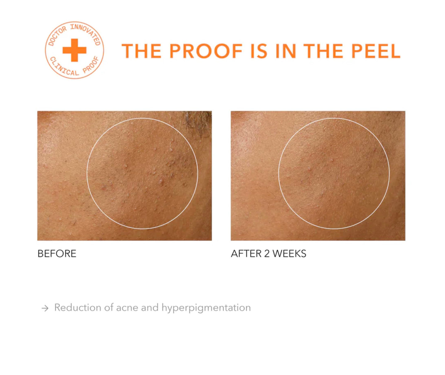 Dr. Dennis Gross Alpha Beta Universal Daily Peel: for Uneven Tone or Texture and Fine Lines or Enlarged Pores, (5 Treatments)