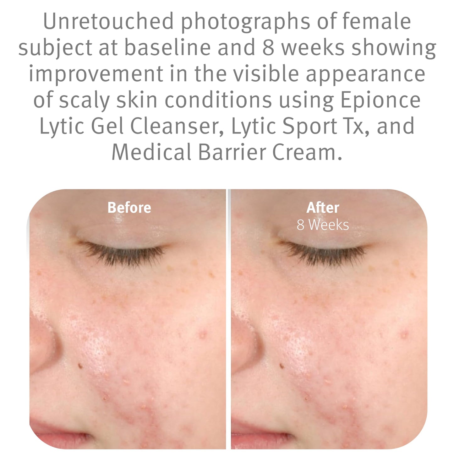 Epionce Lytic Gel Cleanser – Gentle Foaming Face Wash & Makeup Remover for Oily, Combination & Problem Skin with Willow Bark