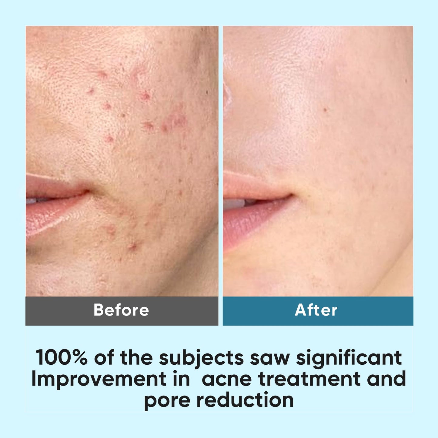 Elvira Glycolic Acid Facial Pads – 10% Glycolic, 2% Salicylic Acid & Niacinamide, 60 Pads Daily Exfoliating Peel for Sensitive Acne Skin