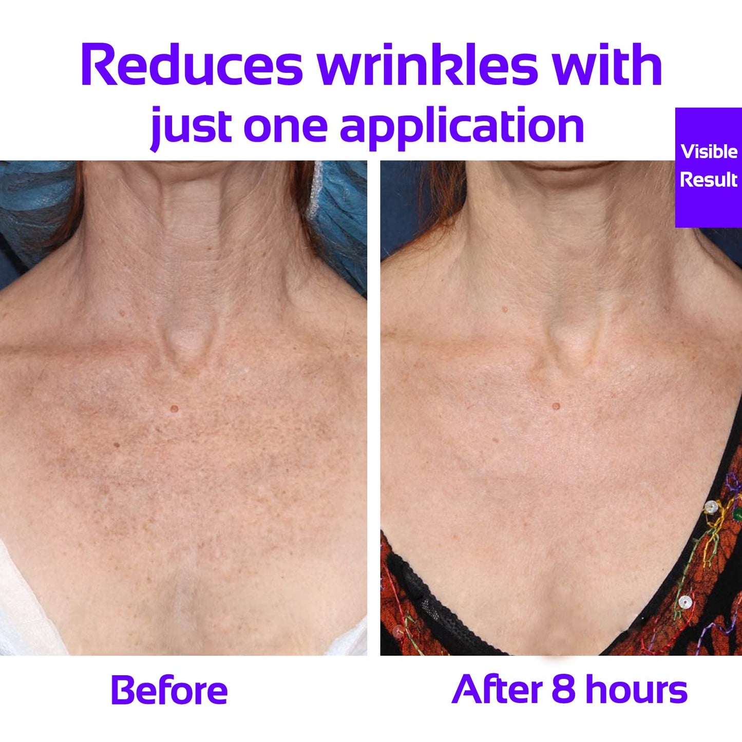 Skywee Professional Anti-Wrinkle Chest Silicone Pads – 100% Medical Grade, Reusable Décolleté Patches to Smooth and Firm Skin, Set of 2