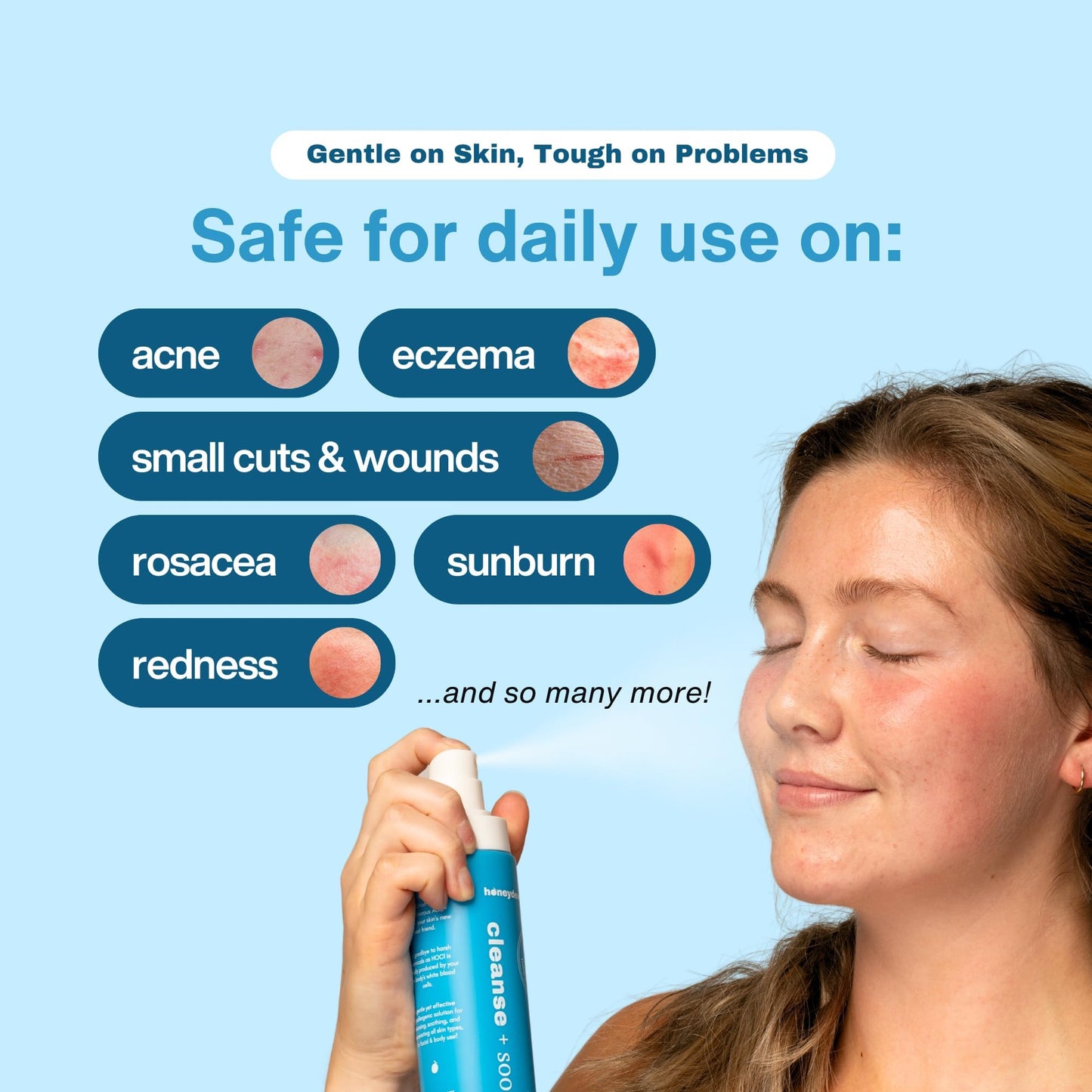 Honeydew Labs Hypochlorous Acid Spray – HOCl Mist for Acne, Eczema, Sensitive Skin, Scalp & Eyelid Care, Post-Workout & Post-Procedure, 6.8oz