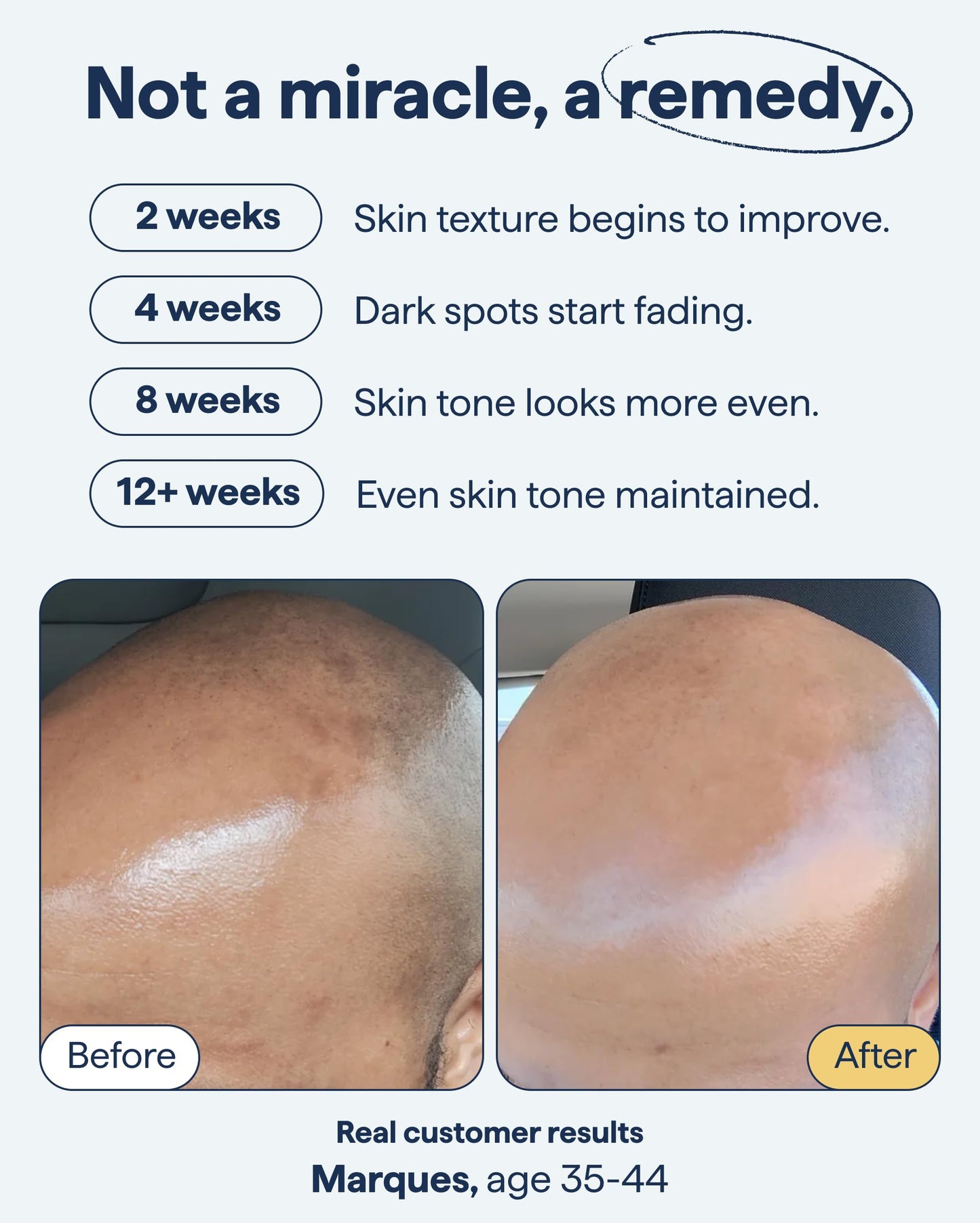 Remedy for Dark Spots – Face Discoloration Treatment with Retinol, Glutathione, Niacinamide, Mandelic & Kojic Acid by Dr. Shah