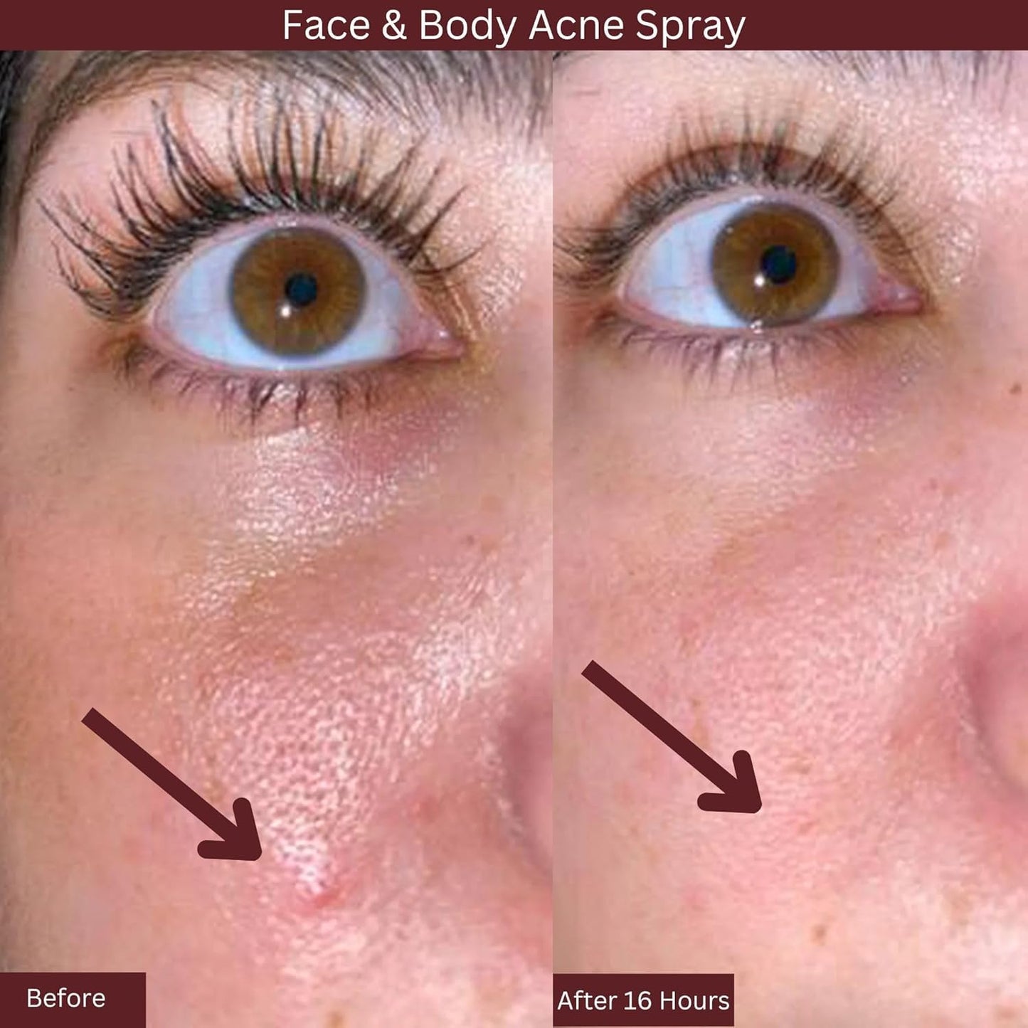 ITK Skincare 2% Salicylic Acid Spray for Face & Body Acne, Blackheads, Pimples & Blemishes – BHA Post-Workout Mist, 3.3oz