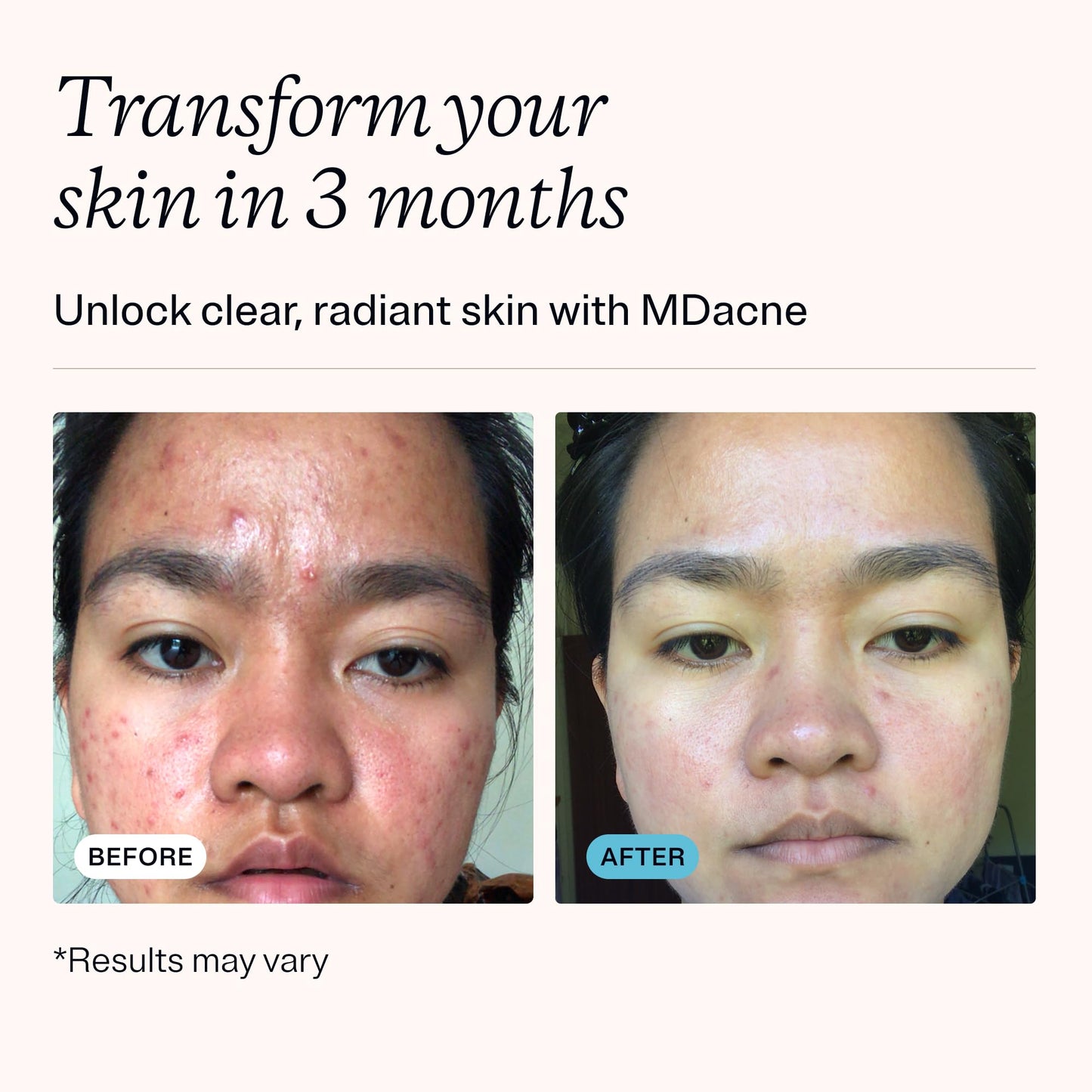 MDacne 3-Step Acne Treatment Kit – Benzoyl Peroxide 2.5% Cream, Salicylic Acid Cleanser, Niacinamide Moisturizer, 30-Day Medicated Kit