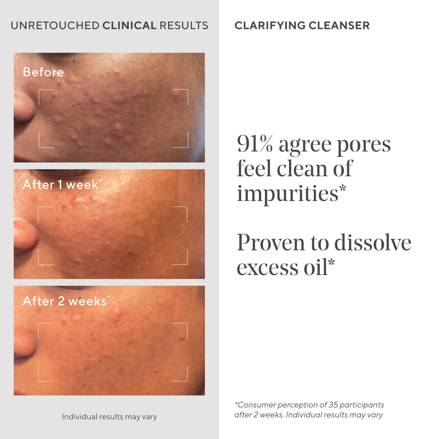 Murad Clarifying Cleanser – Salicylic Acid & Green Tea for Acne, Deep Clean, Oil Control & Breakout Prevention, 5 fl. oz