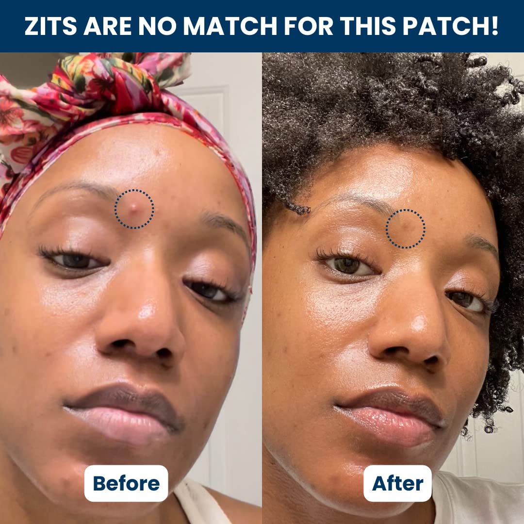 CLEAN SKIN CLUB 60 Vegan Invisible Pimple Patches – Hydrocolloid Zit & Blemish Stickers, Blackhead Absorbing, Non-Toxic Skincare Treatment