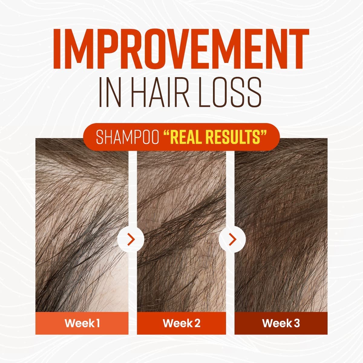 CRAZY SKIN German Beer Yeast Biotin Shampoo 300ml – Anti-Hair Loss, Thickening, Hard Water Defense, Gentle Exfoliating, Sulfate-Free Formula