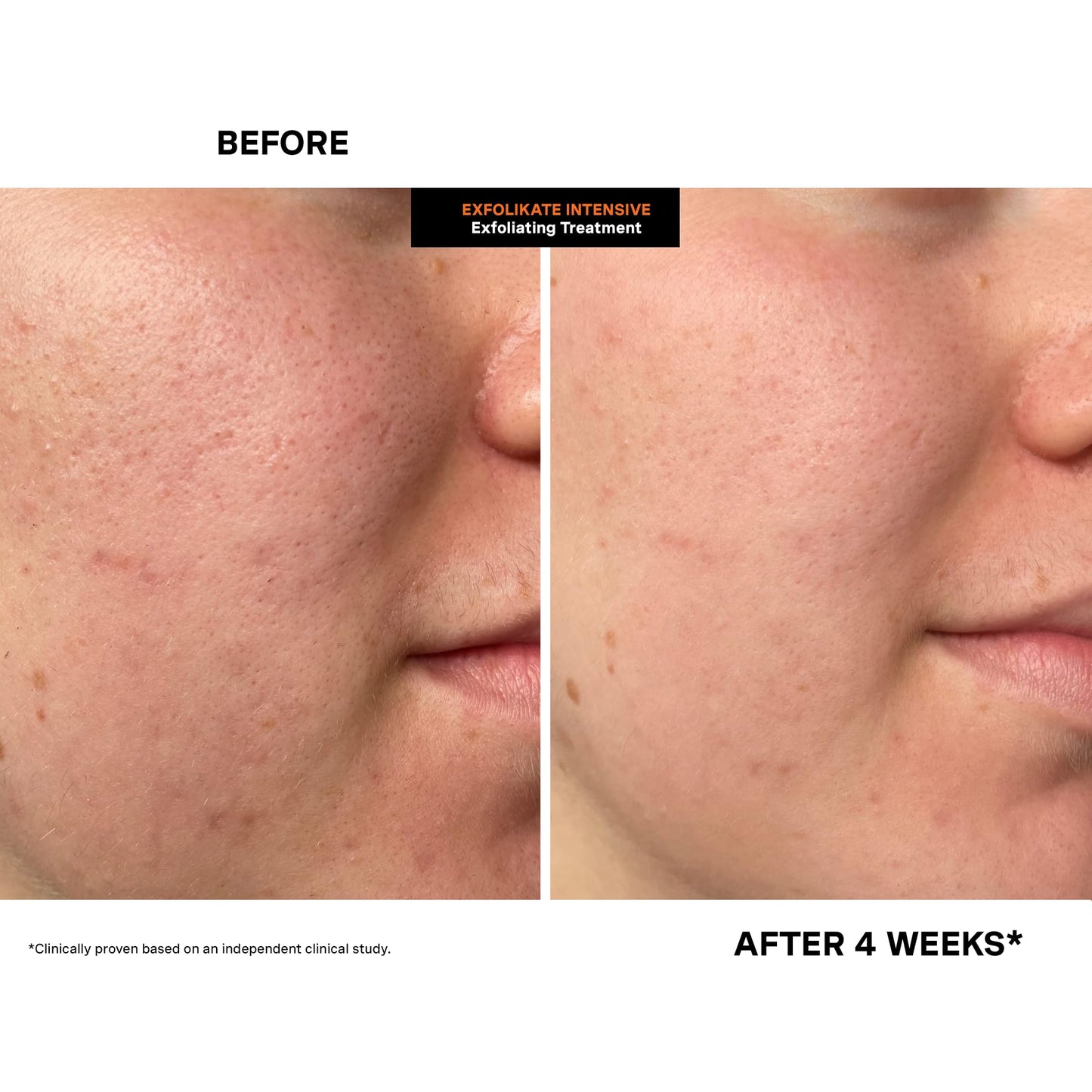 Kate Somerville ExfoliKate Intensive Exfoliating Treatment – Super Facial Scrub & Mask with Salicylic & Lactic Acid, 0.5 fl oz