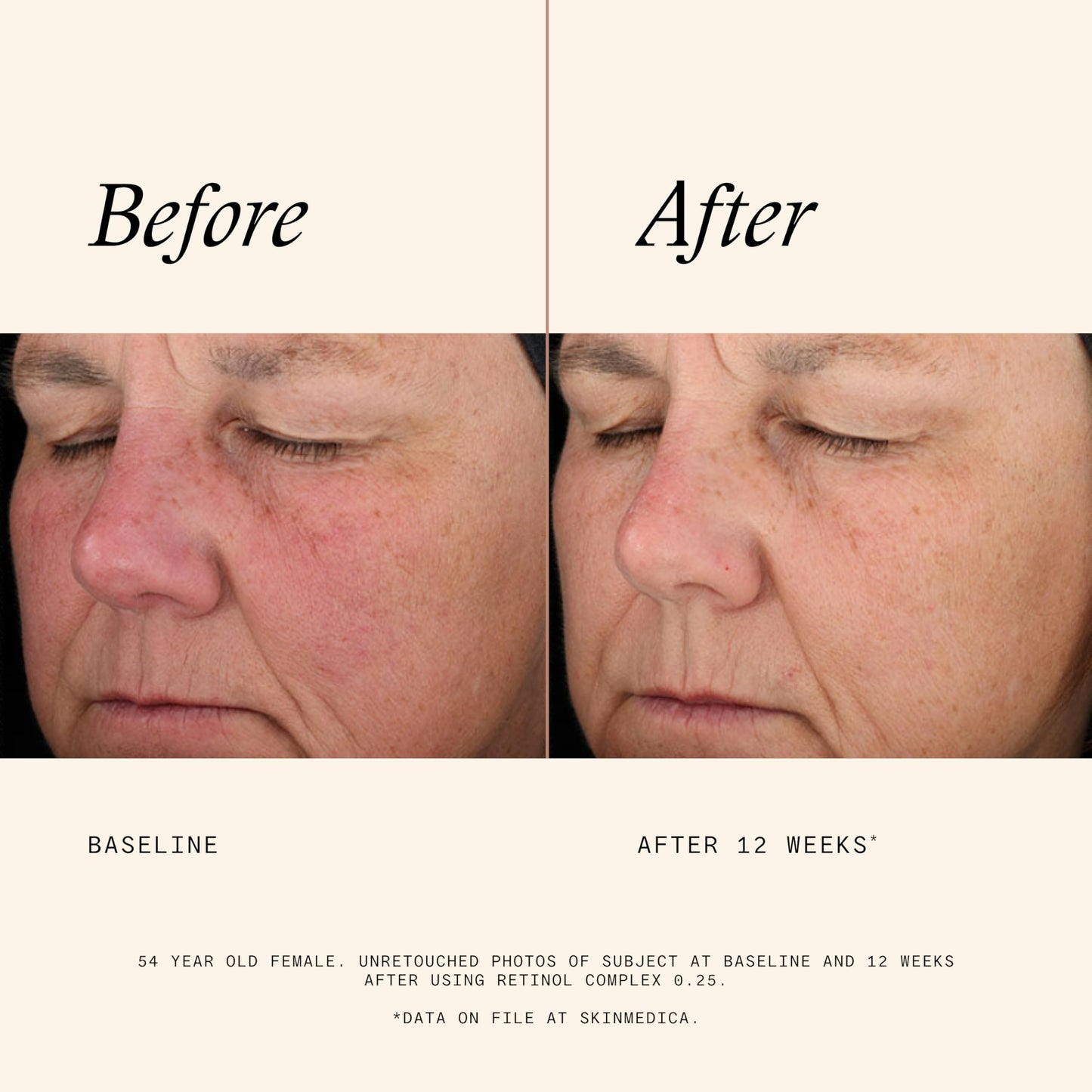 SkinMedica Retinol 0.25 Complex - Advanced Age-Defying Retinol Serum for Face, Reduces Fine Lines & Wrinkles, 1 Fl Oz