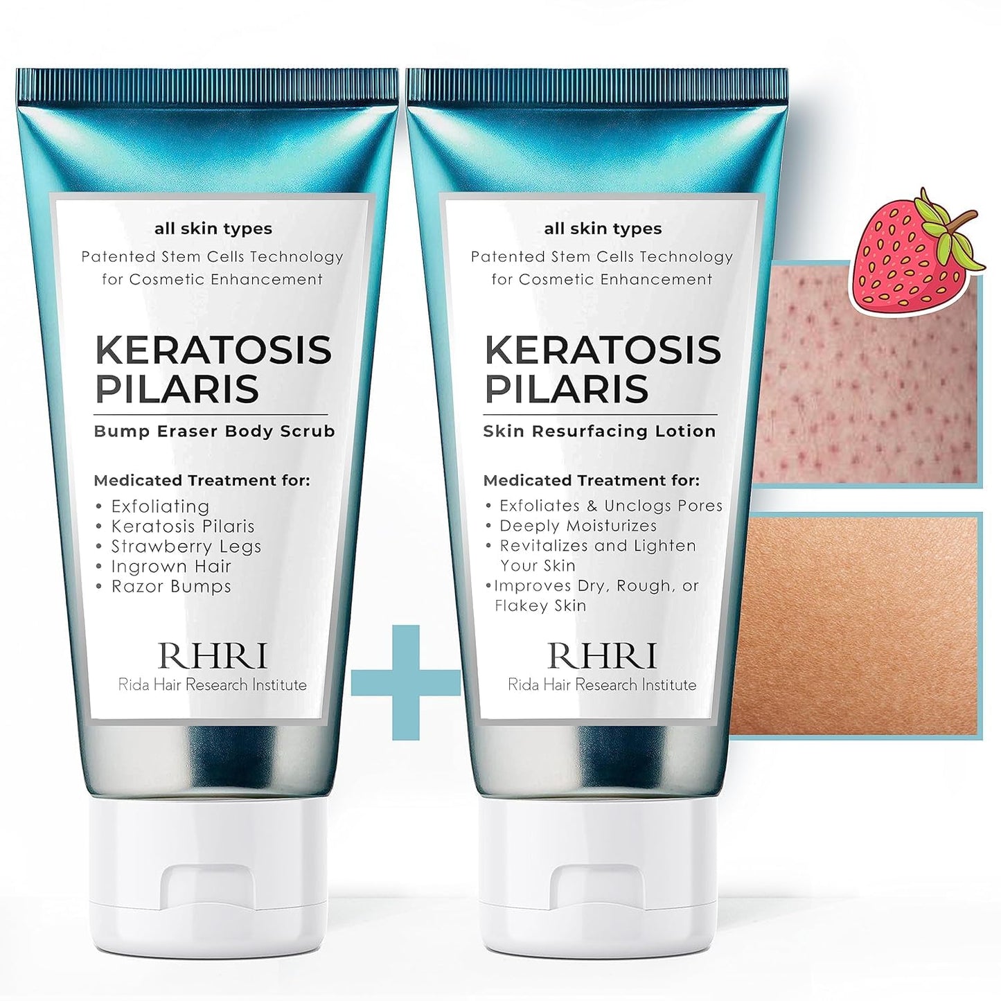 KP Bump Eraser Body Set – Keratosis Pilaris Lotion & Exfoliating Scrub for Strawberry Legs, Bumps, Redness & Dry Flaky Skin