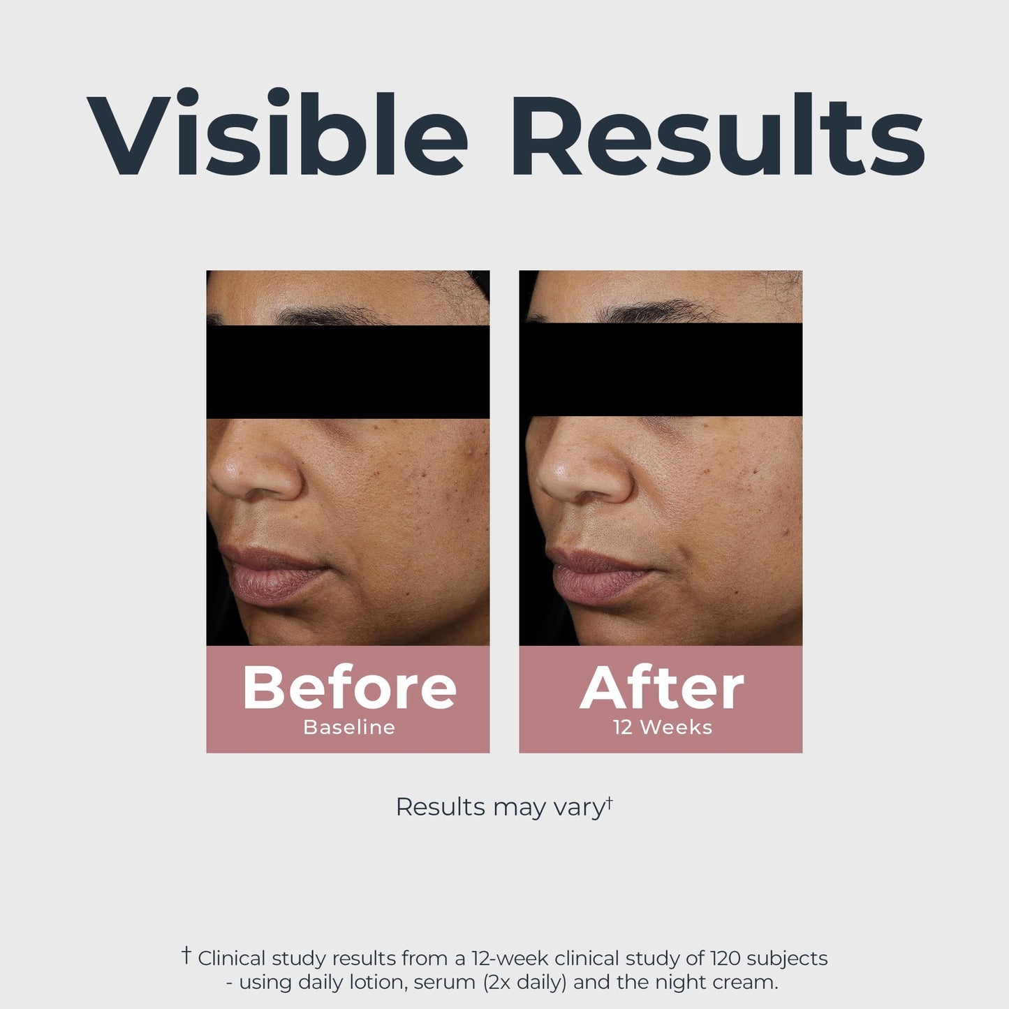 Eucerin Radiant Tone Dual Serum – Dark Spot Corrector with Thiamidol & Hyaluronic Acid, Reduces Persistent Dark Spots, 1 fl. oz.